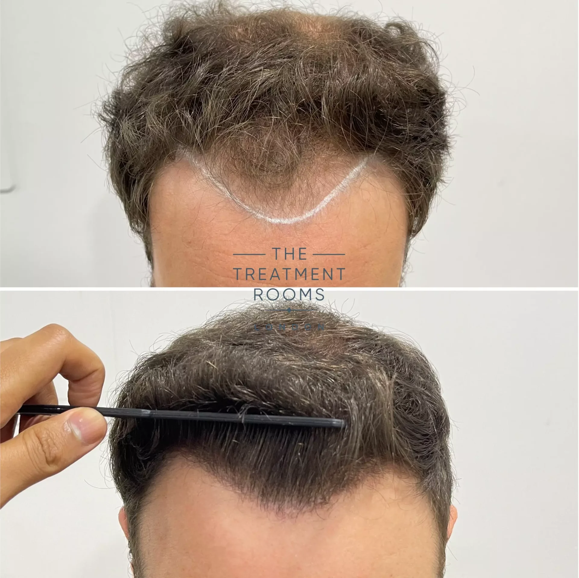 norwood 4 fue hair transplant before and after 1736 grafts