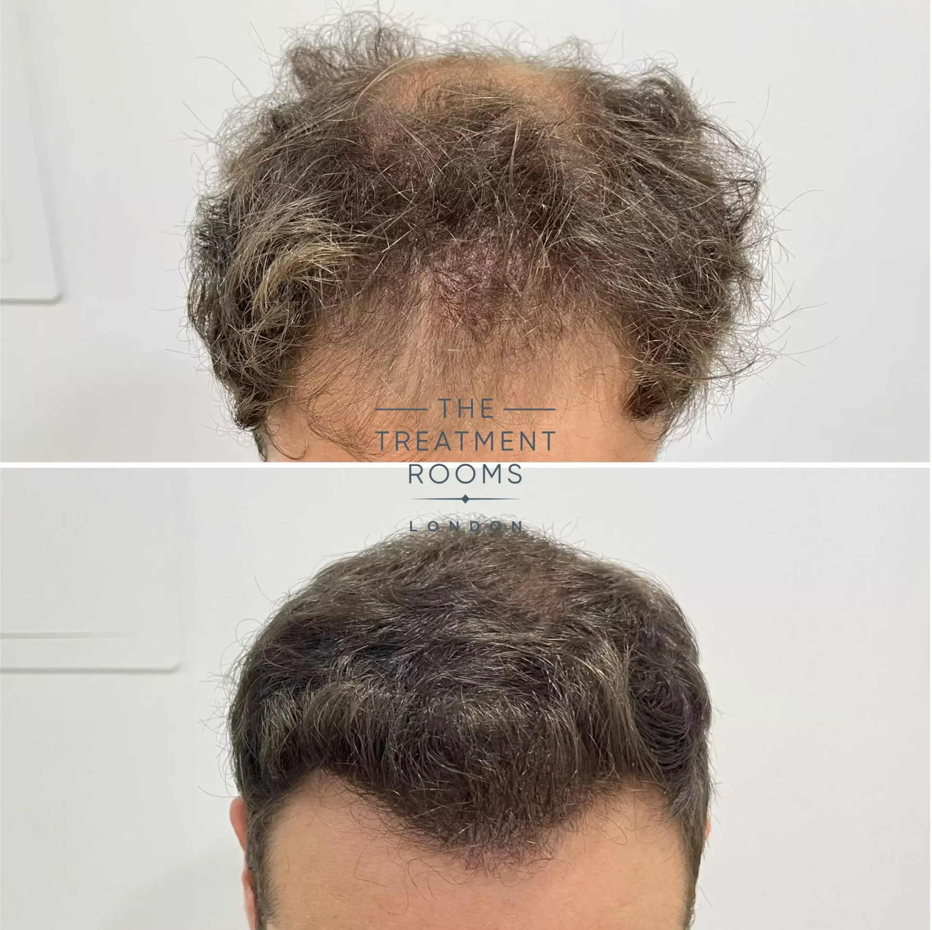 norwood 4 hair transplant before and after 1736 grafts