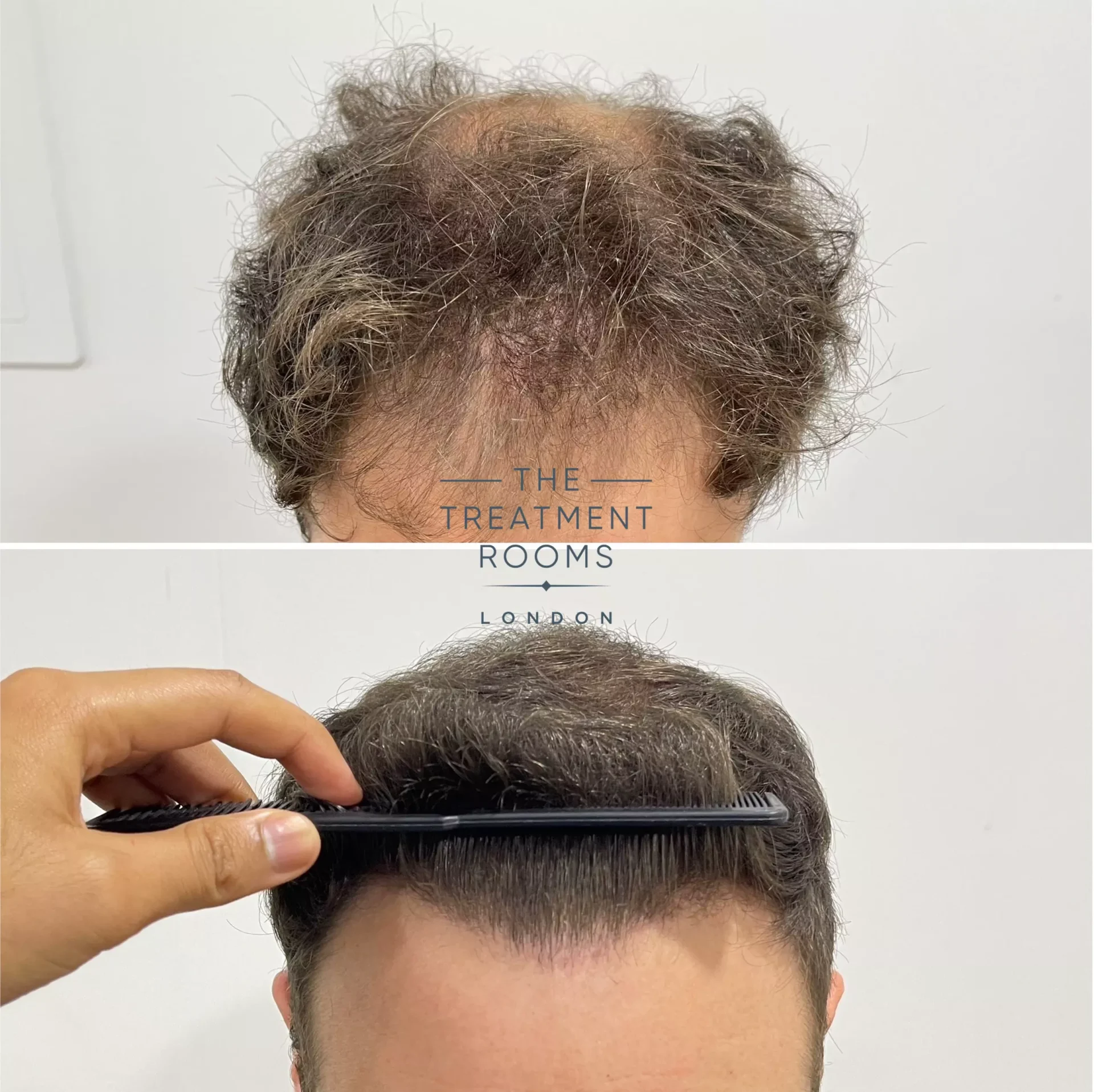 norwood 4 hair transplant result 1736 grafts