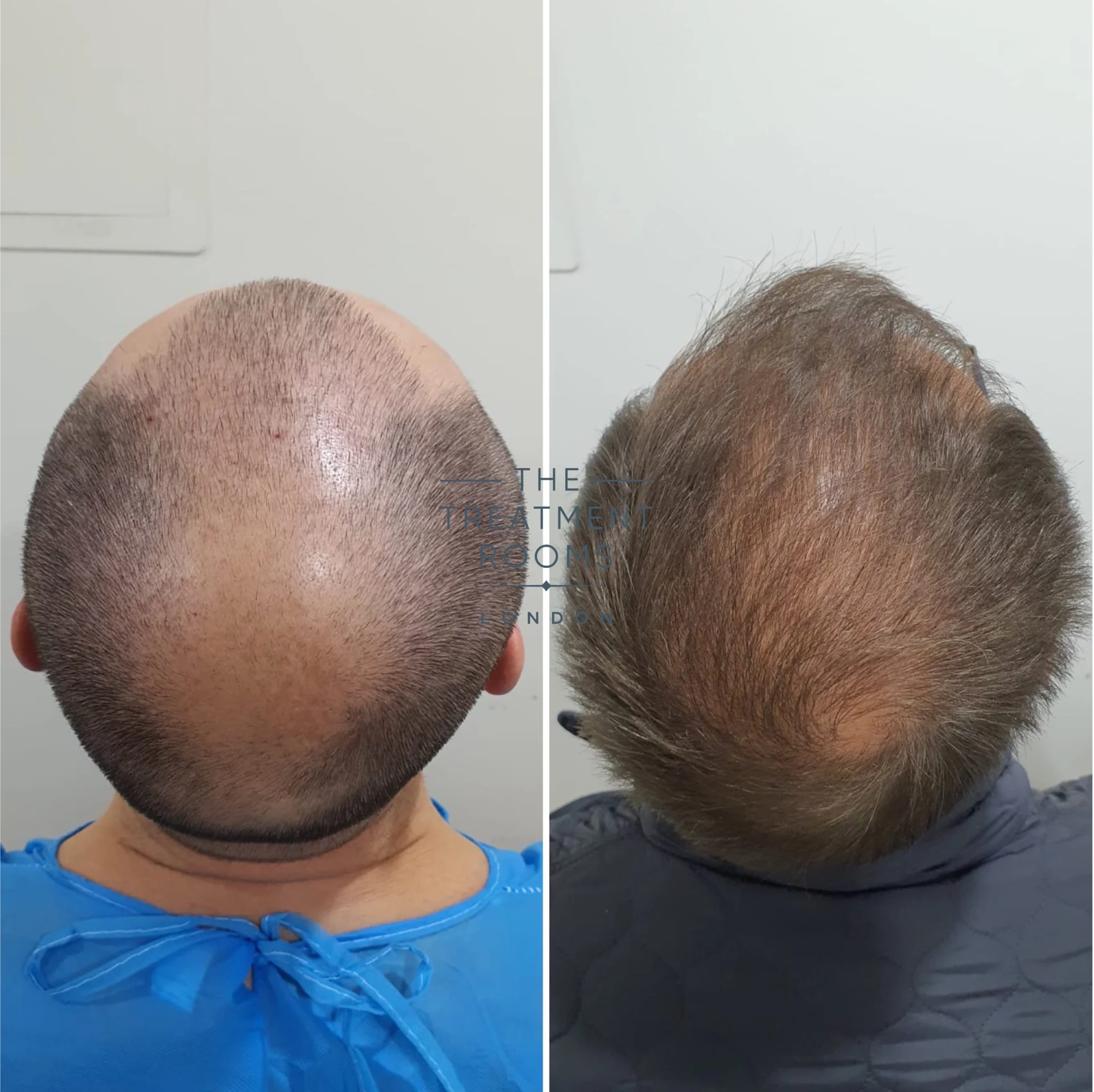 norwood 7 hair loss fue hair transplant