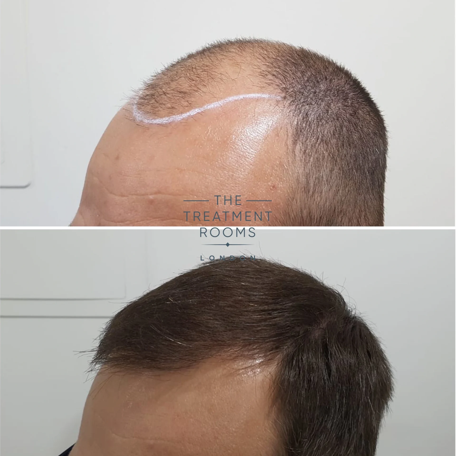 norwood 7 hair loss hair transplant