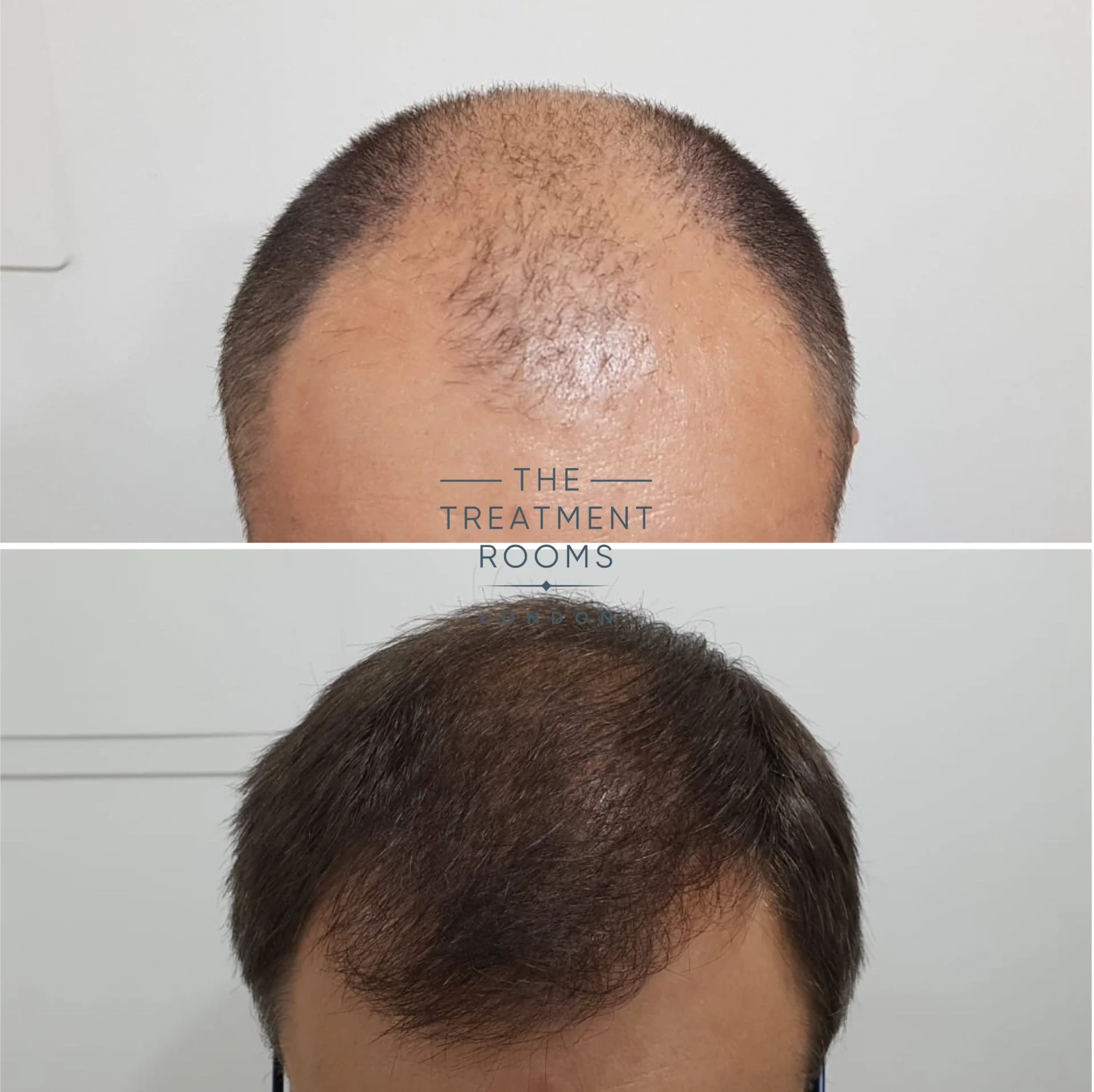 norwood 7 hair transplant cost