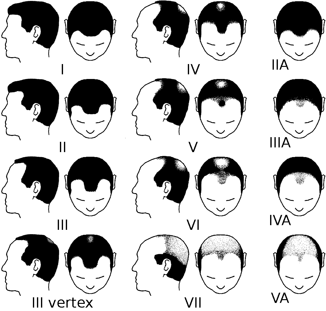norwood scale for hair loss