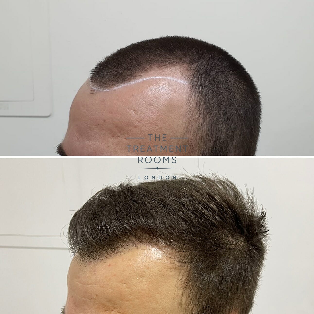 receding hairline before and after hair transplant