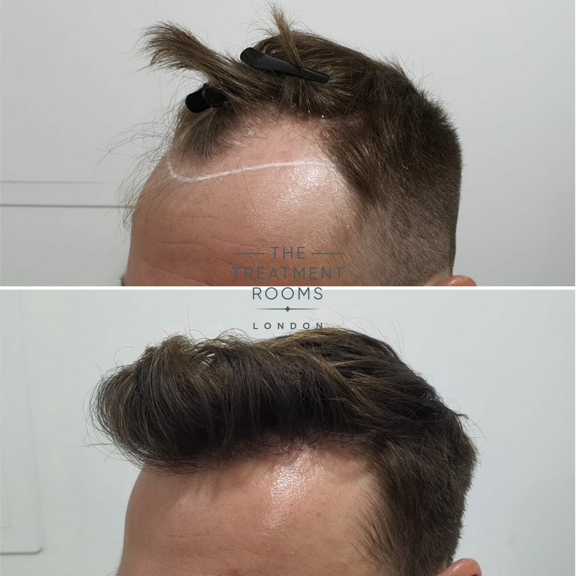 receding hairline dhi hair transplant before and after 1724 grafts