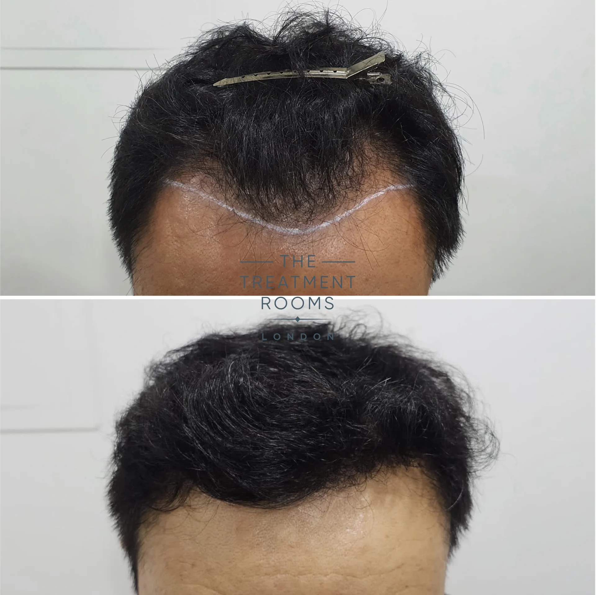 receding hairline fue hair transplant 1178 grafts result