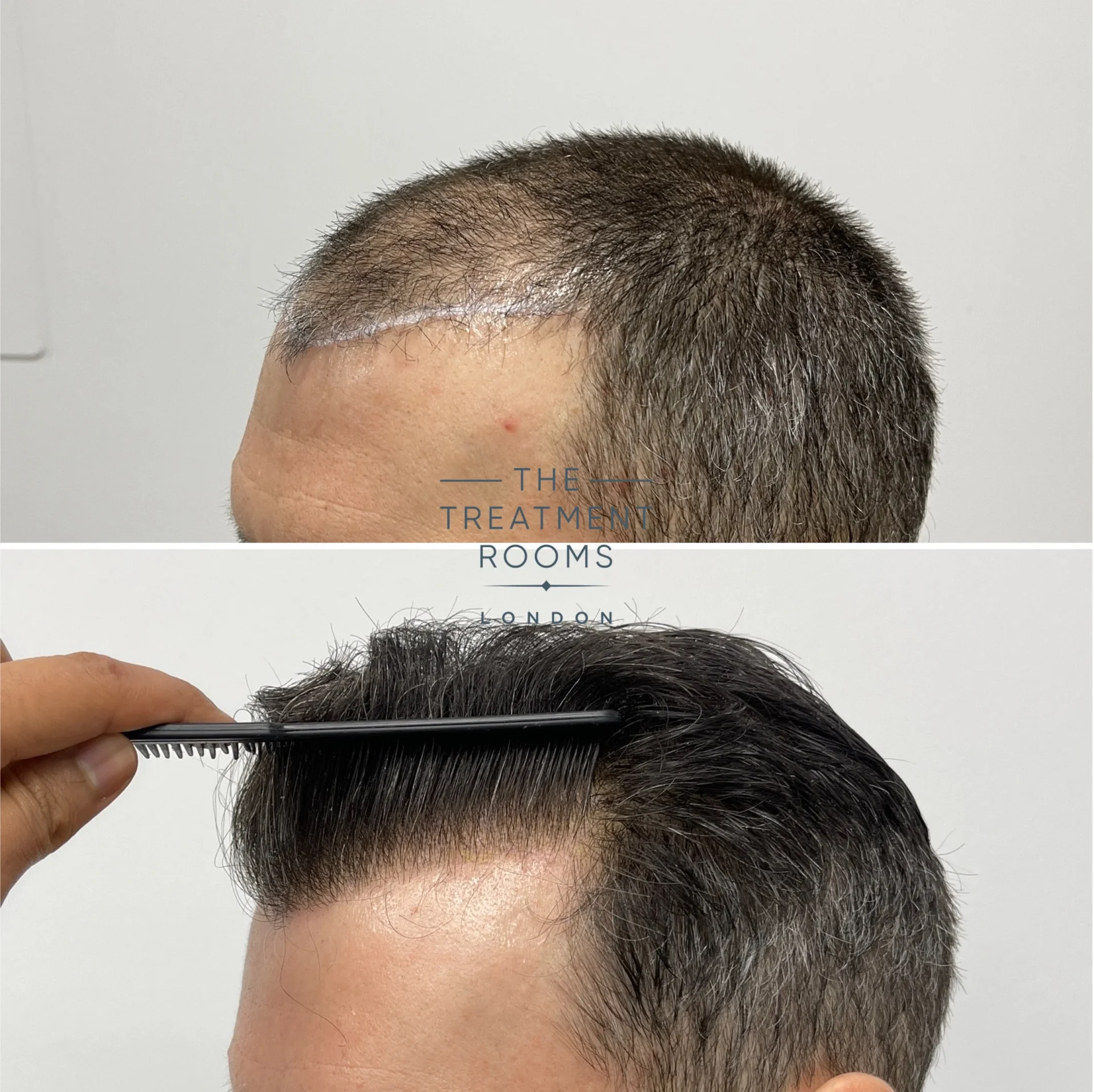 receding hairline fue hair transplant 1748 grafts before and after