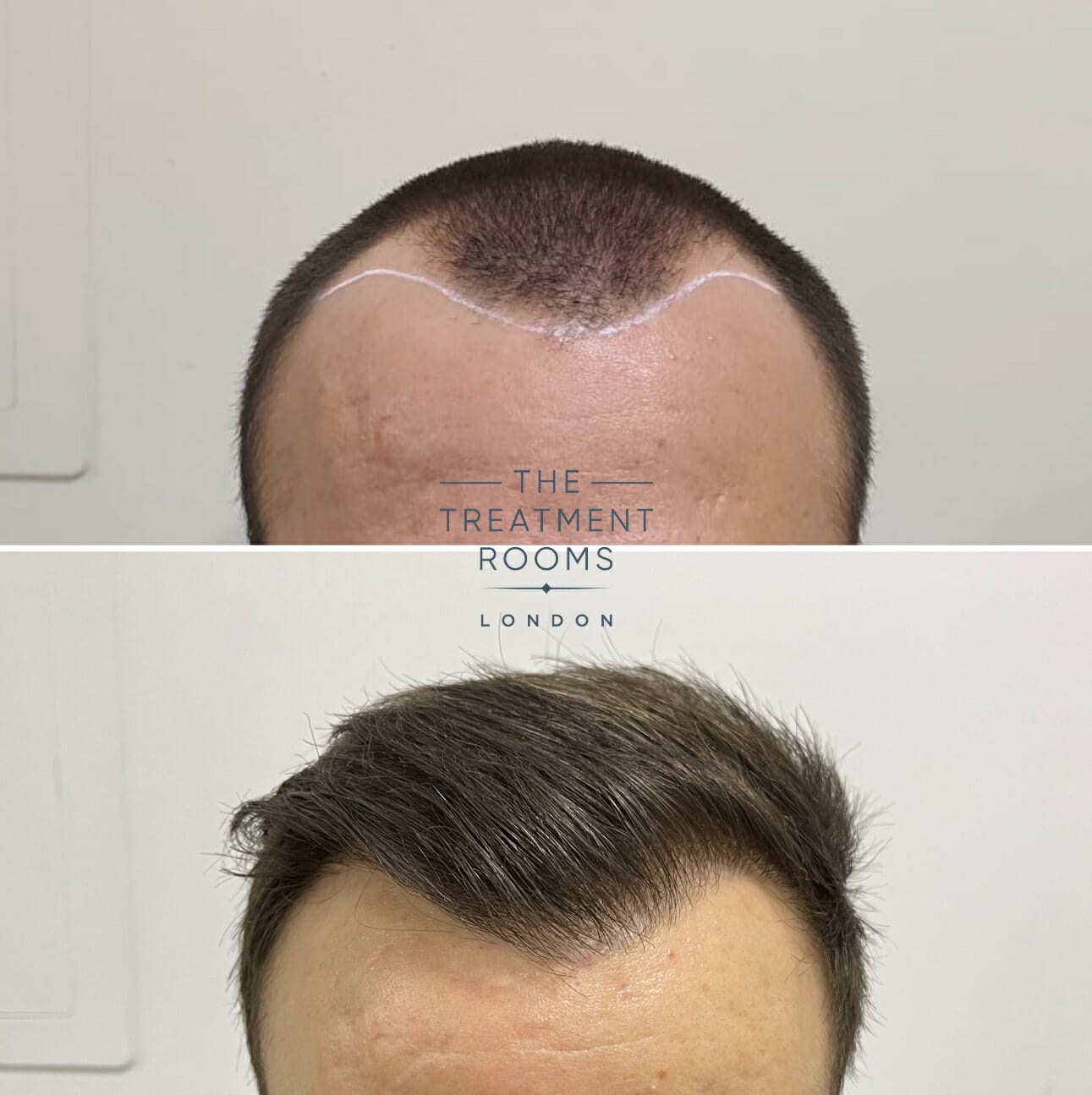 receding hairline fue hair transplant