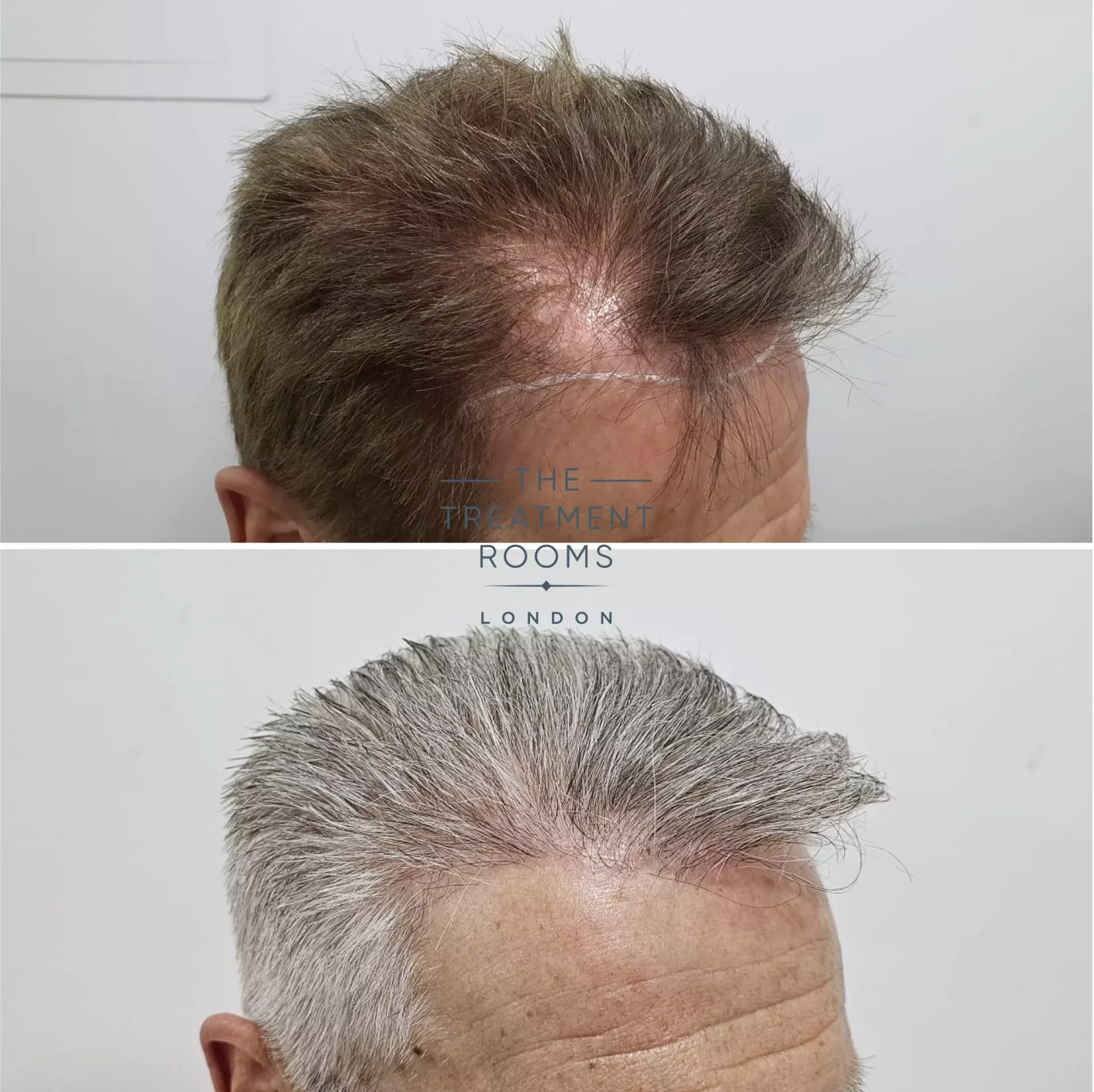 receding hairline fue hair transplant 2126 grafts