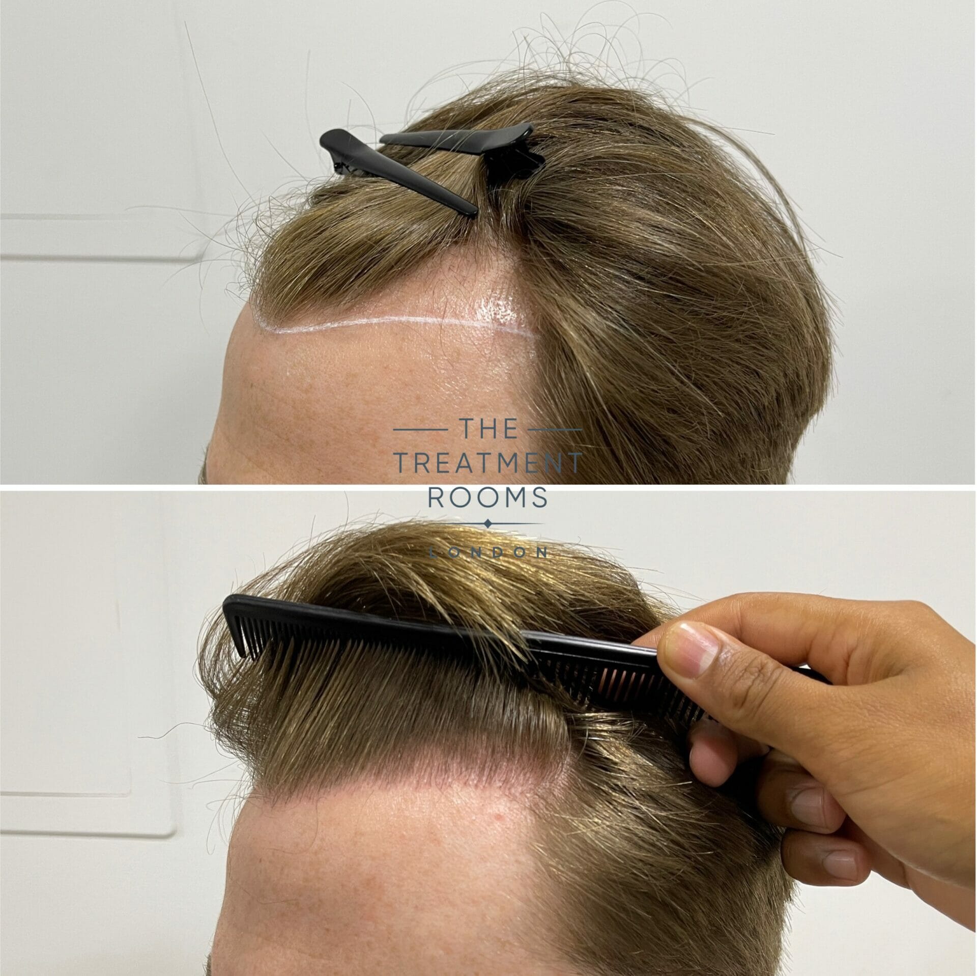 receding hairline fue hair transplant before and after 1700 grafts