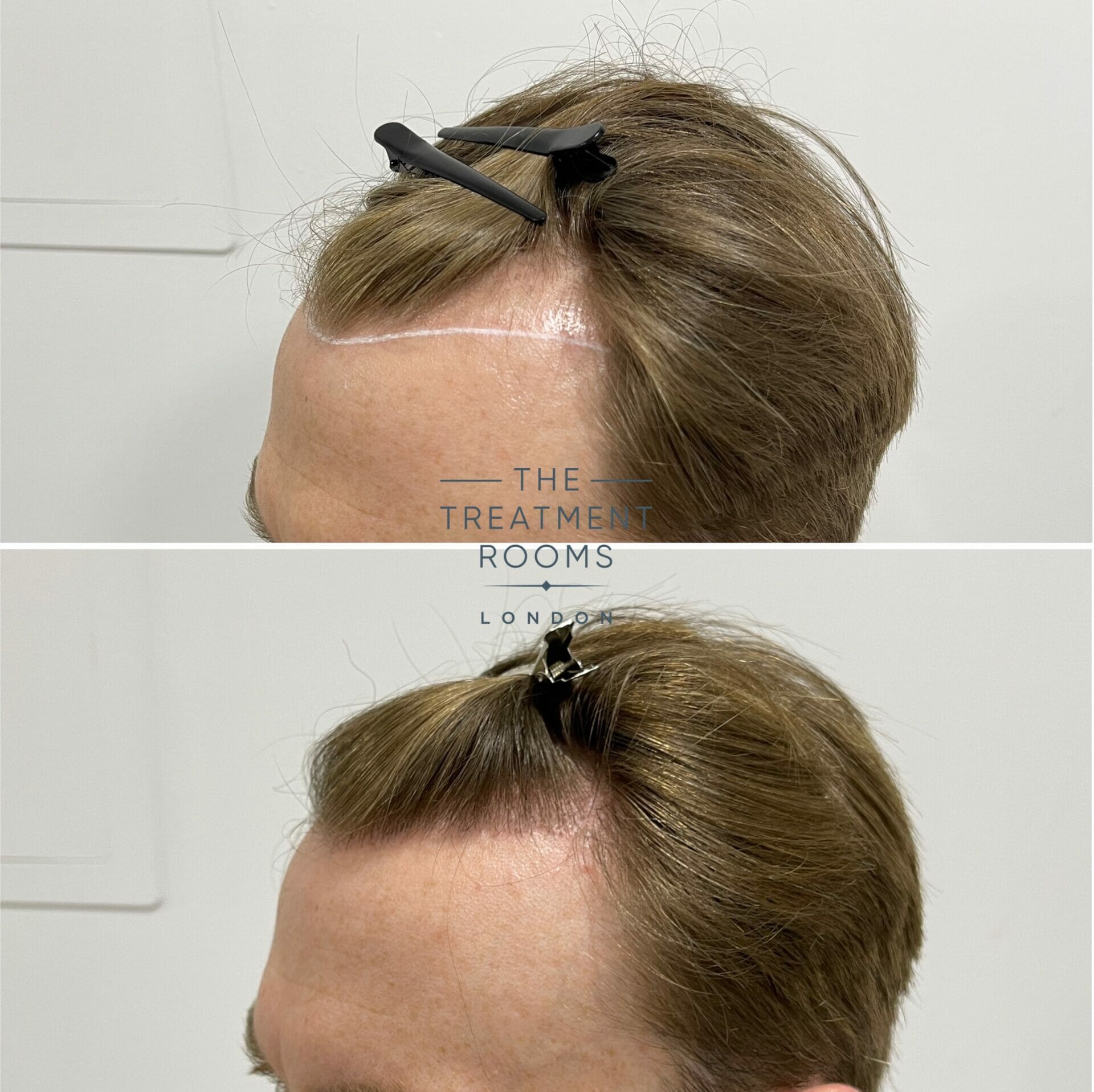 receding hairline fue hair transplant example 1700 grafts