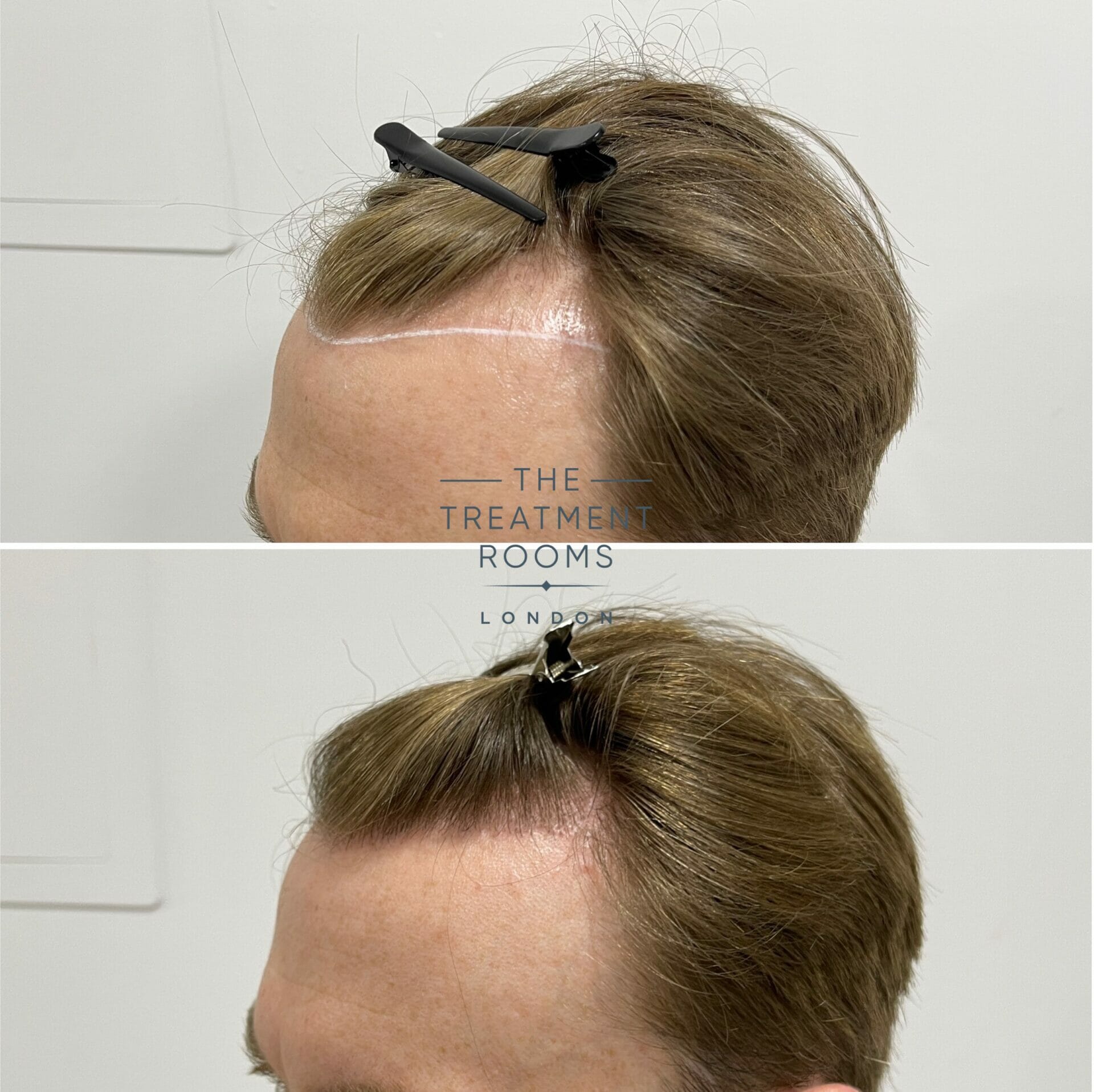 receding hairline fue hair transplant example 1700 grafts