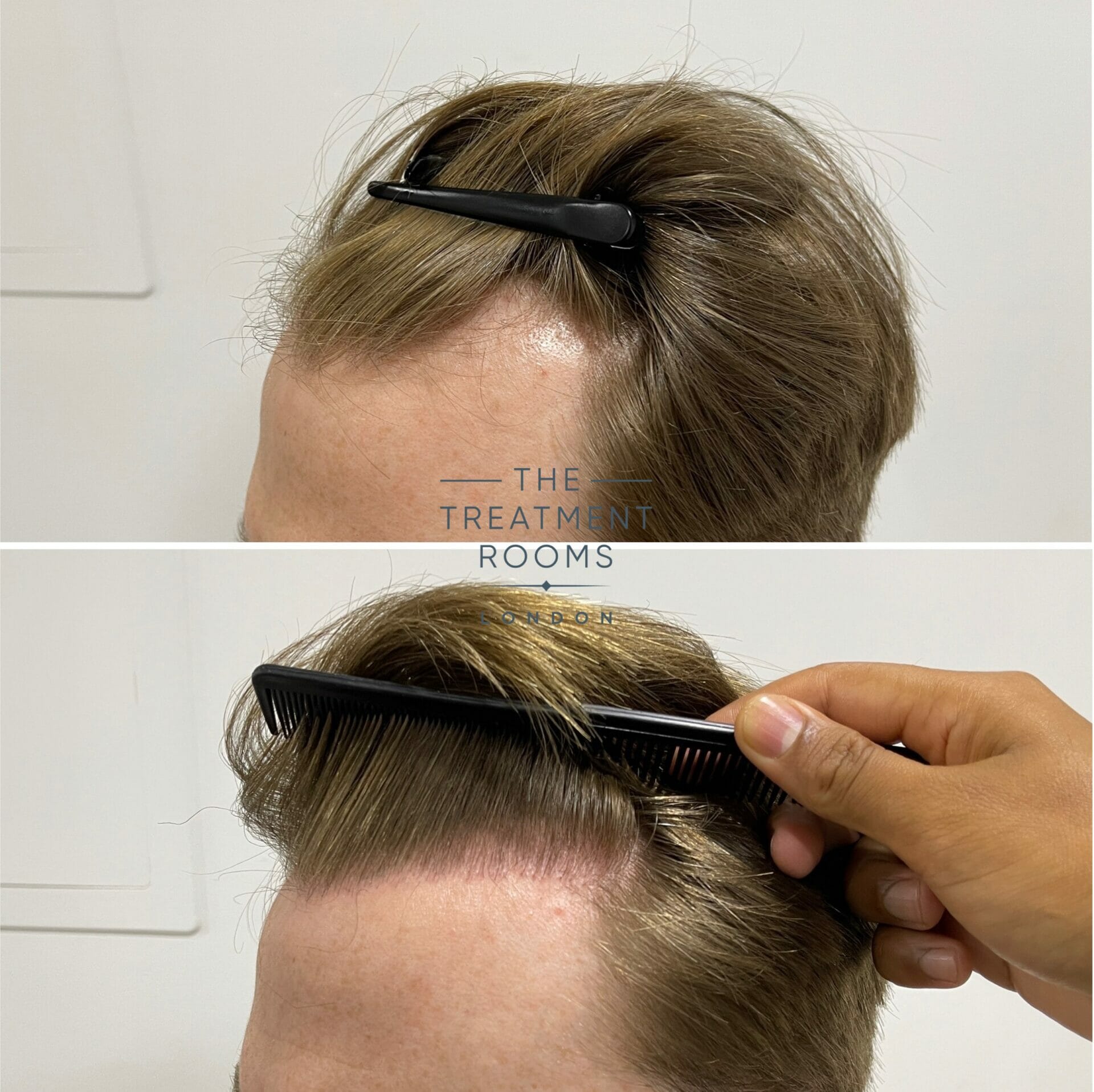 receding hairline fue hair transplant result 1700 grafts