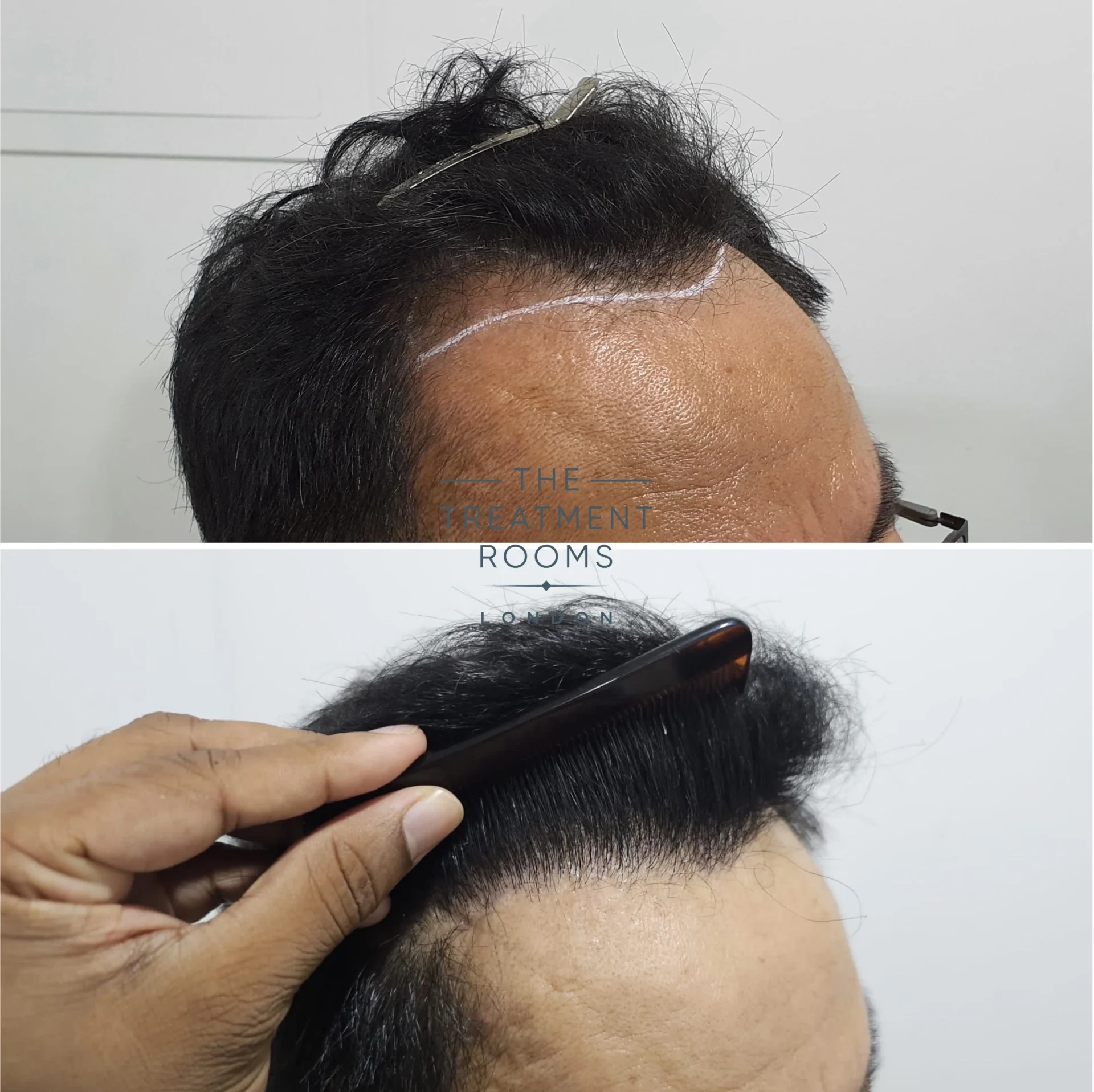 receding hairline hair transplant 1178 grafts result