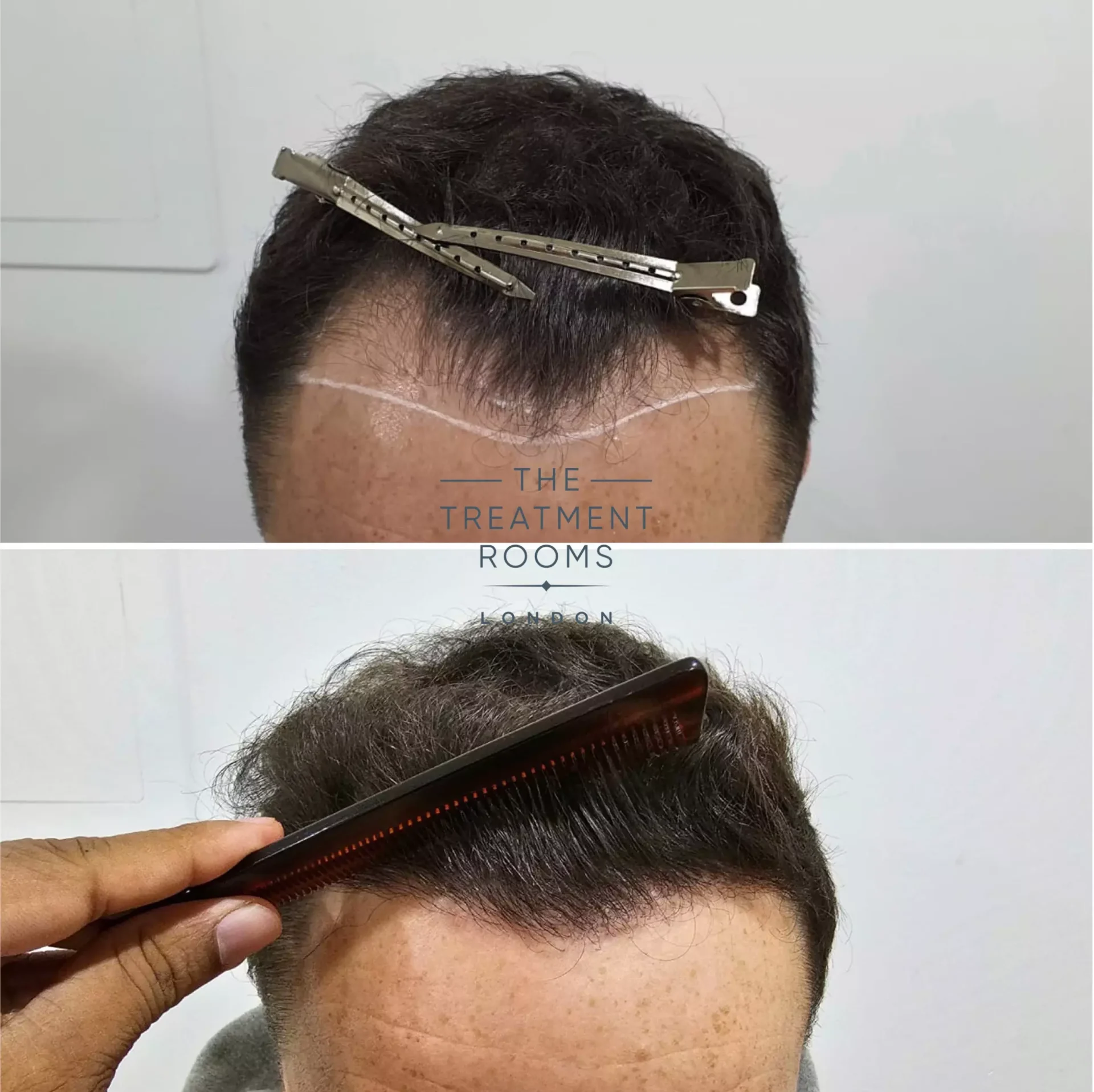receding hairline hair transplant 1303 grafts before and after