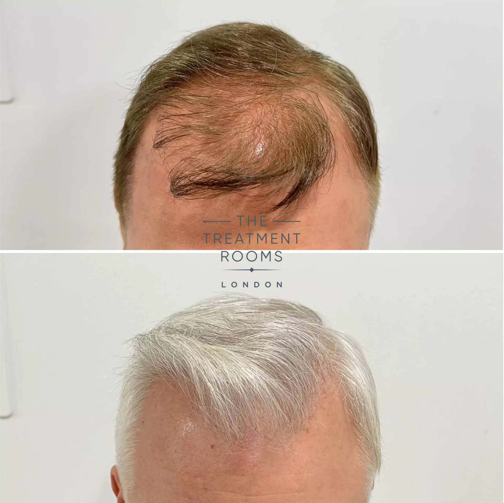 receding hairline hair transplant 1495 grafts before and after