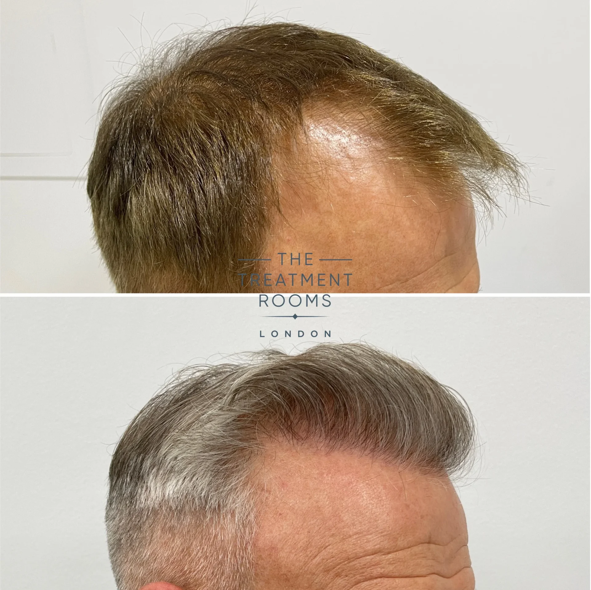 receding hairline hair transplant 1602 grafts before and after.