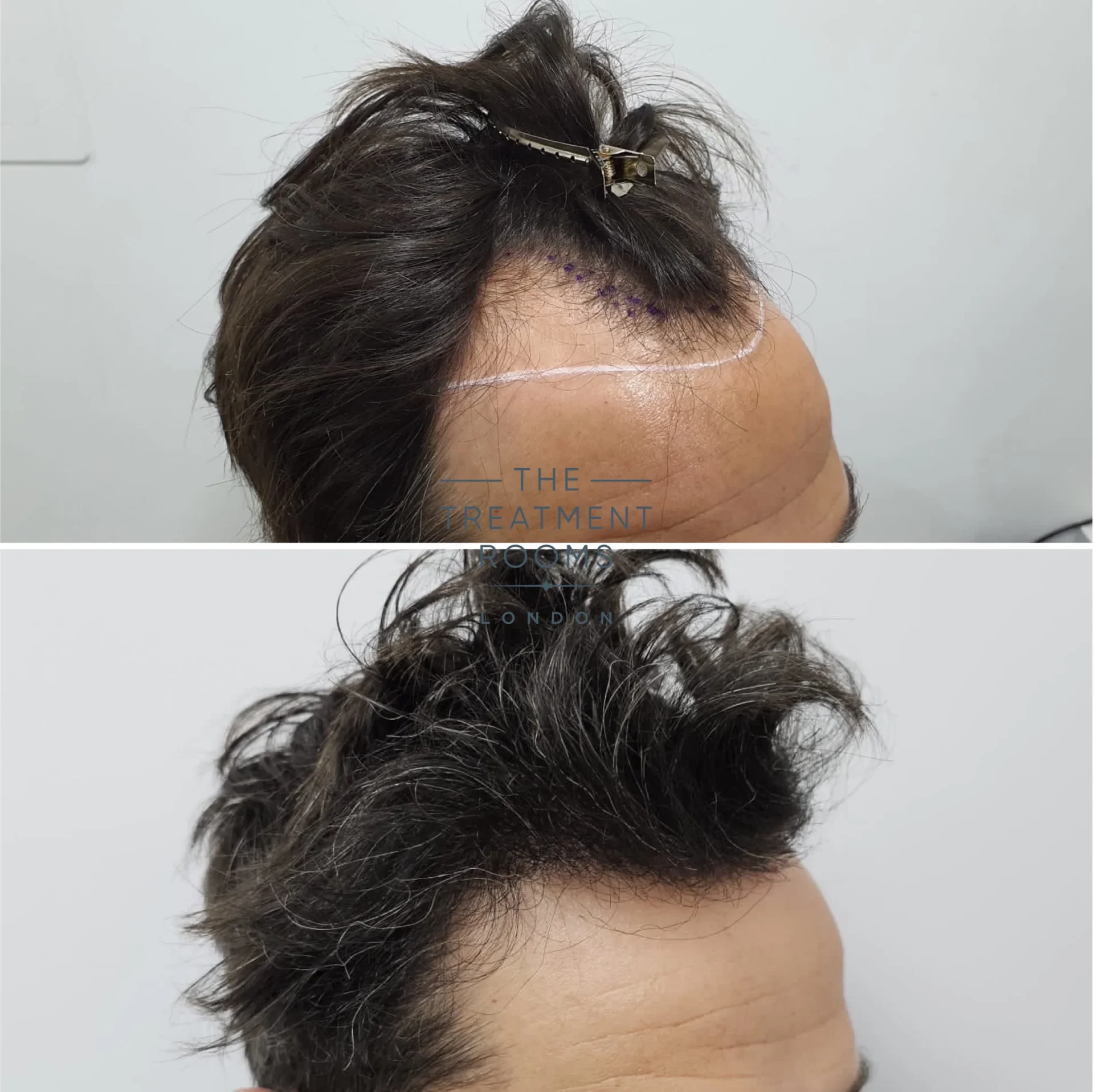 receding hairline hair transplant 1739 grafts