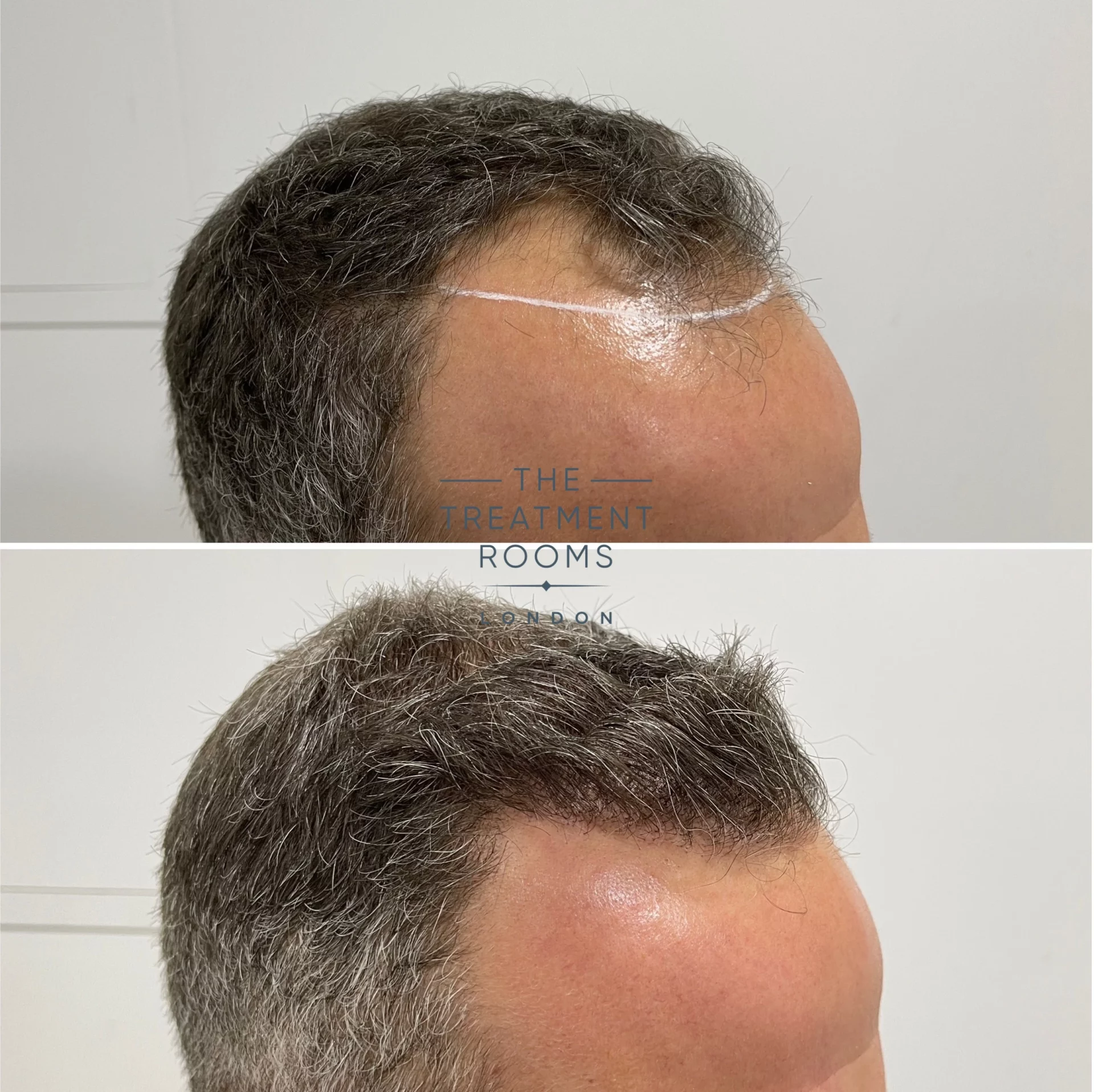 receding hairline hair transplant 1788 grafts result