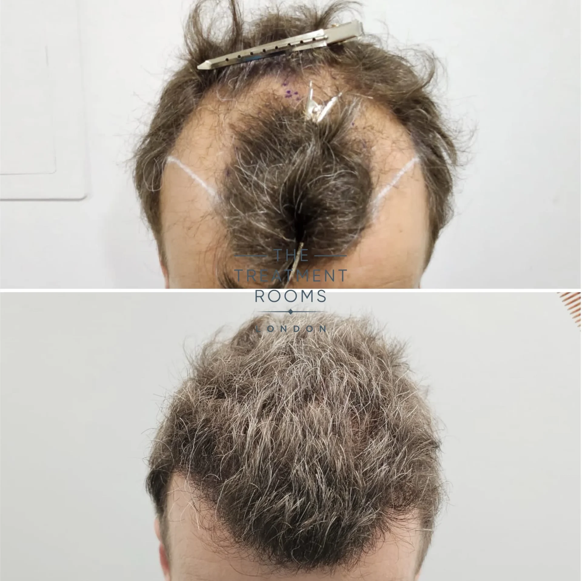 receding hairline hair transplant 1977 grafts grey hair
