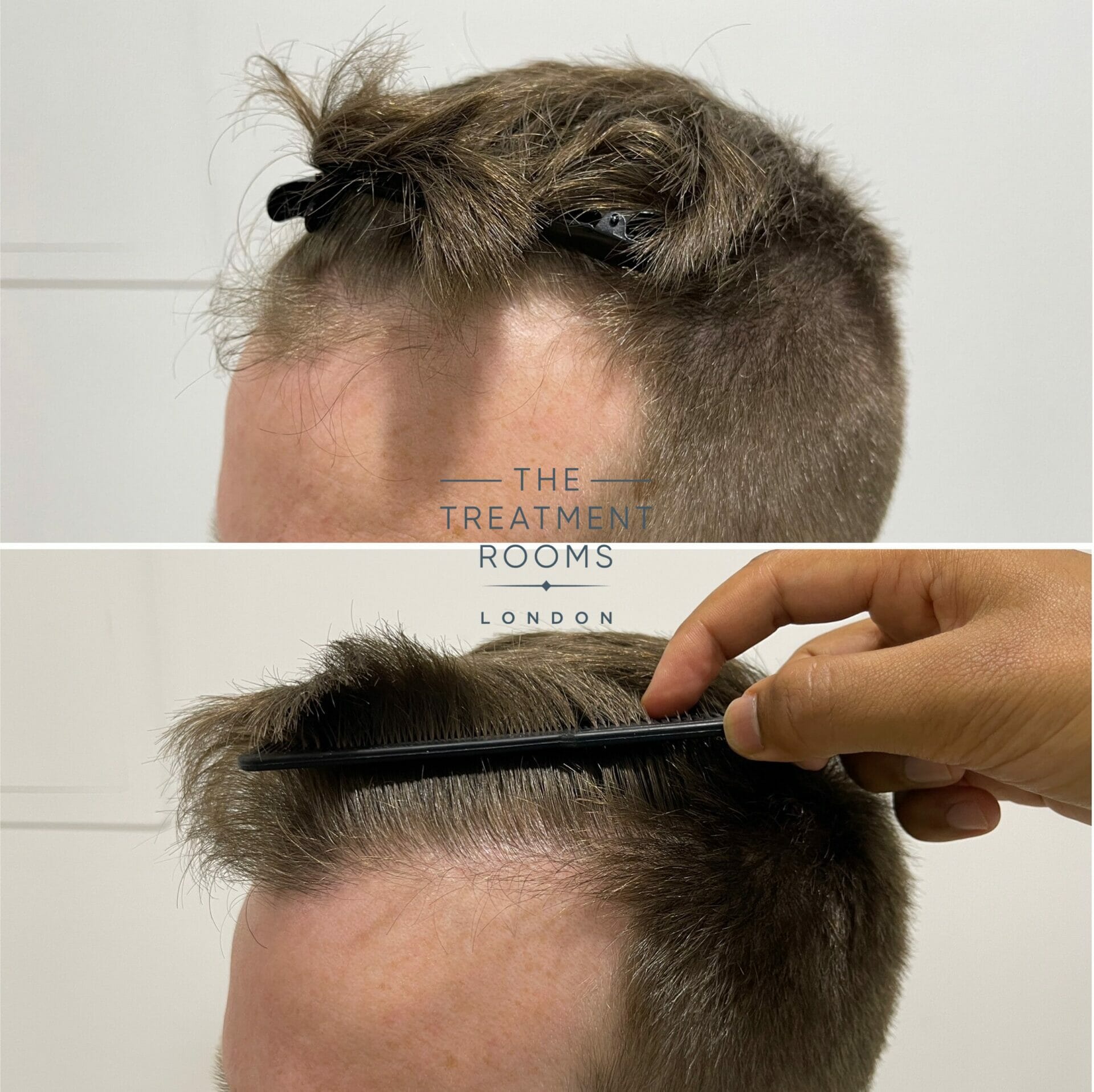 receding hairline hair transplant before and after closeup