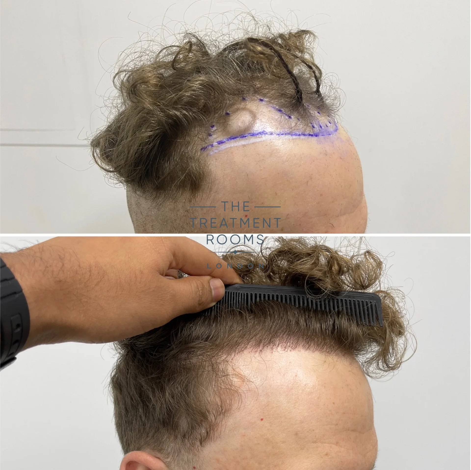 receding hairline hair transplant clinic london 1514 grafts before and after