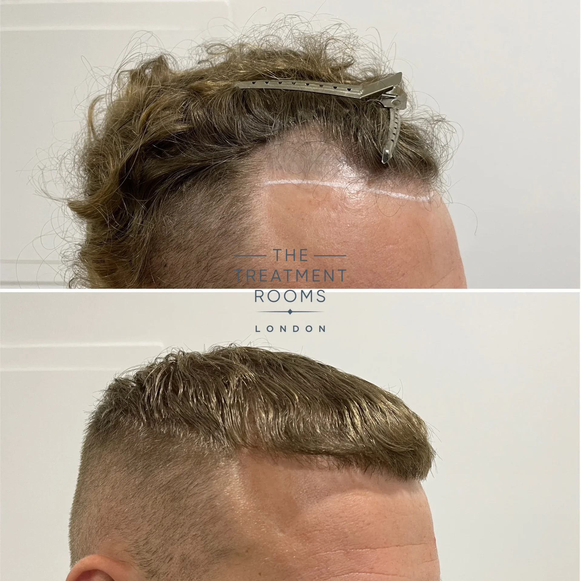 receding hairline hair transplant london 1294 grafts