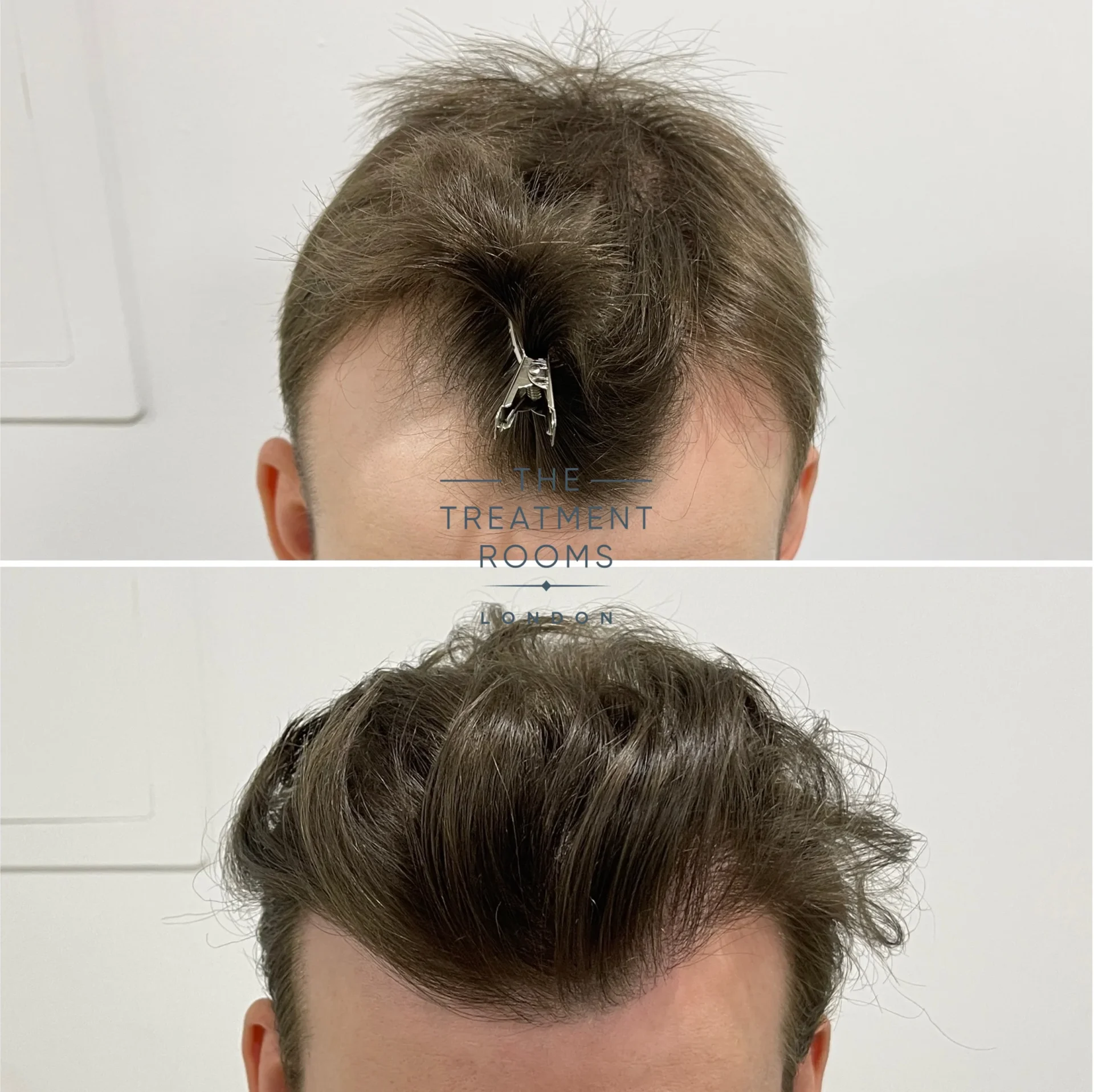 receding hairline m shaped