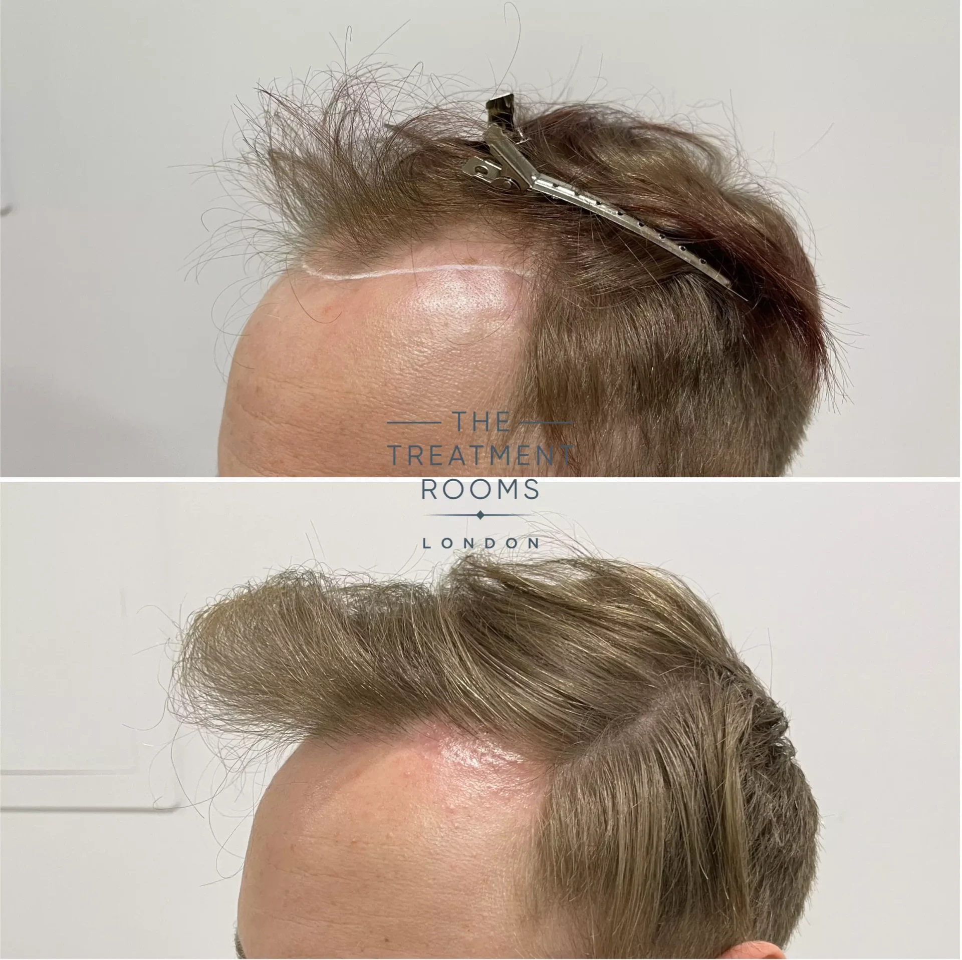 receding hairline transplant 1693 grafts before and after