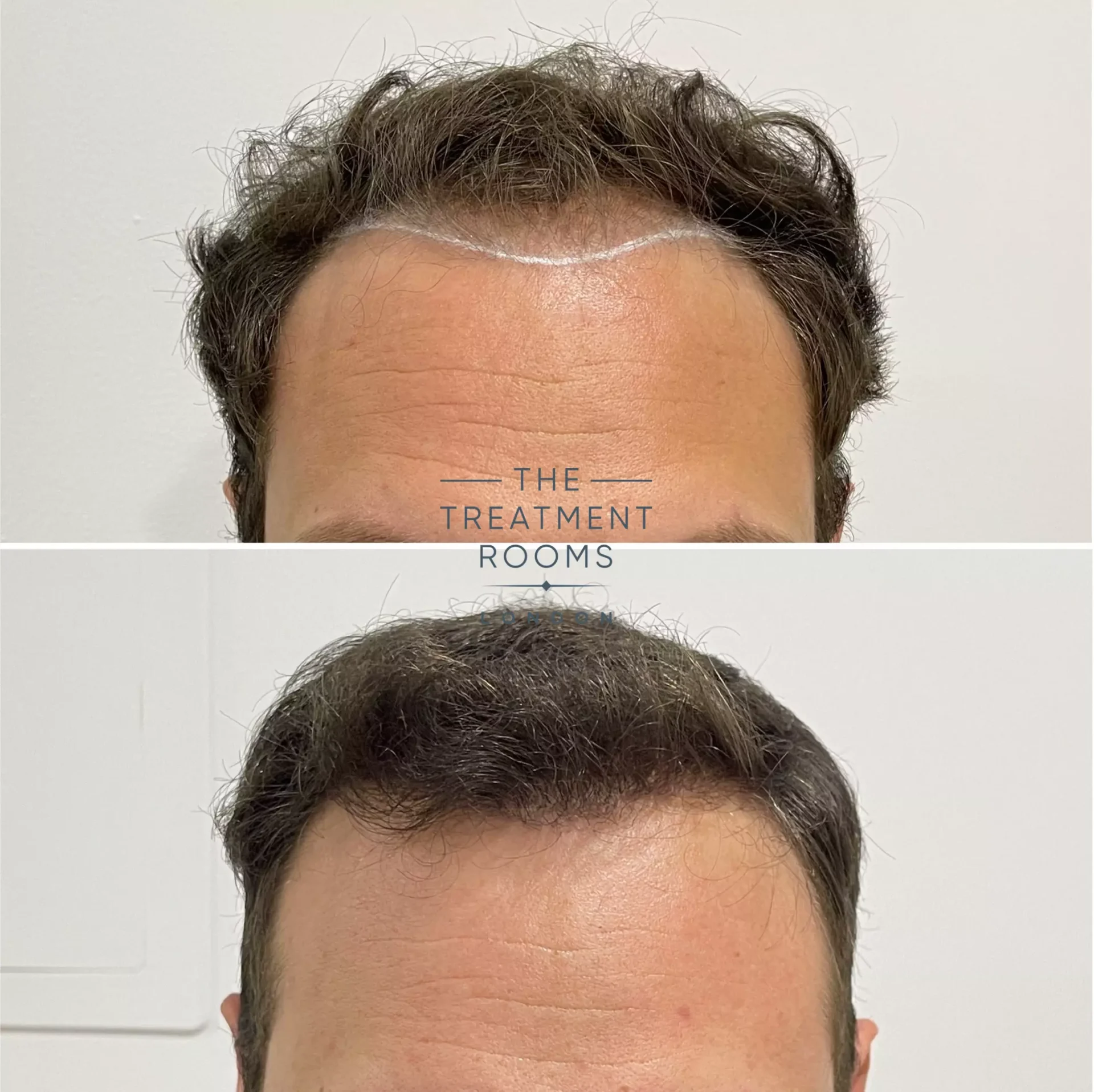 receding hairline transplant before and after 1736 grafts