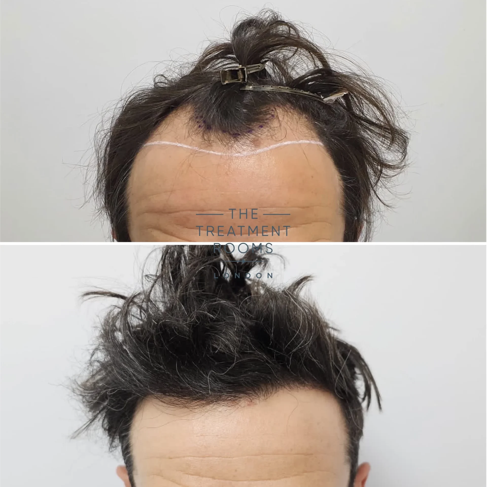 receding hairline transplant before and after 1739 grafts