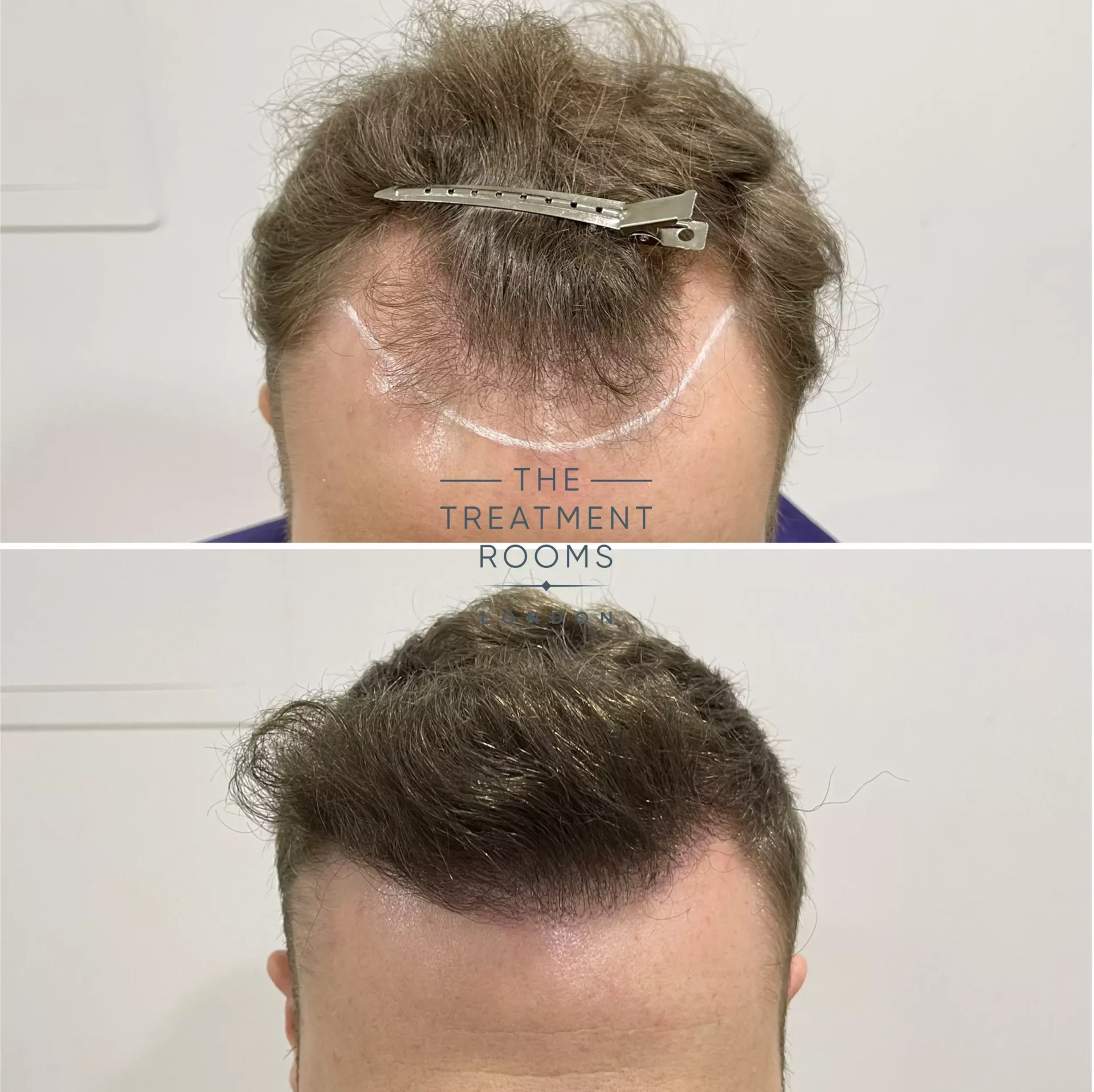 receding hairline transplant london 1346 grafts before and after