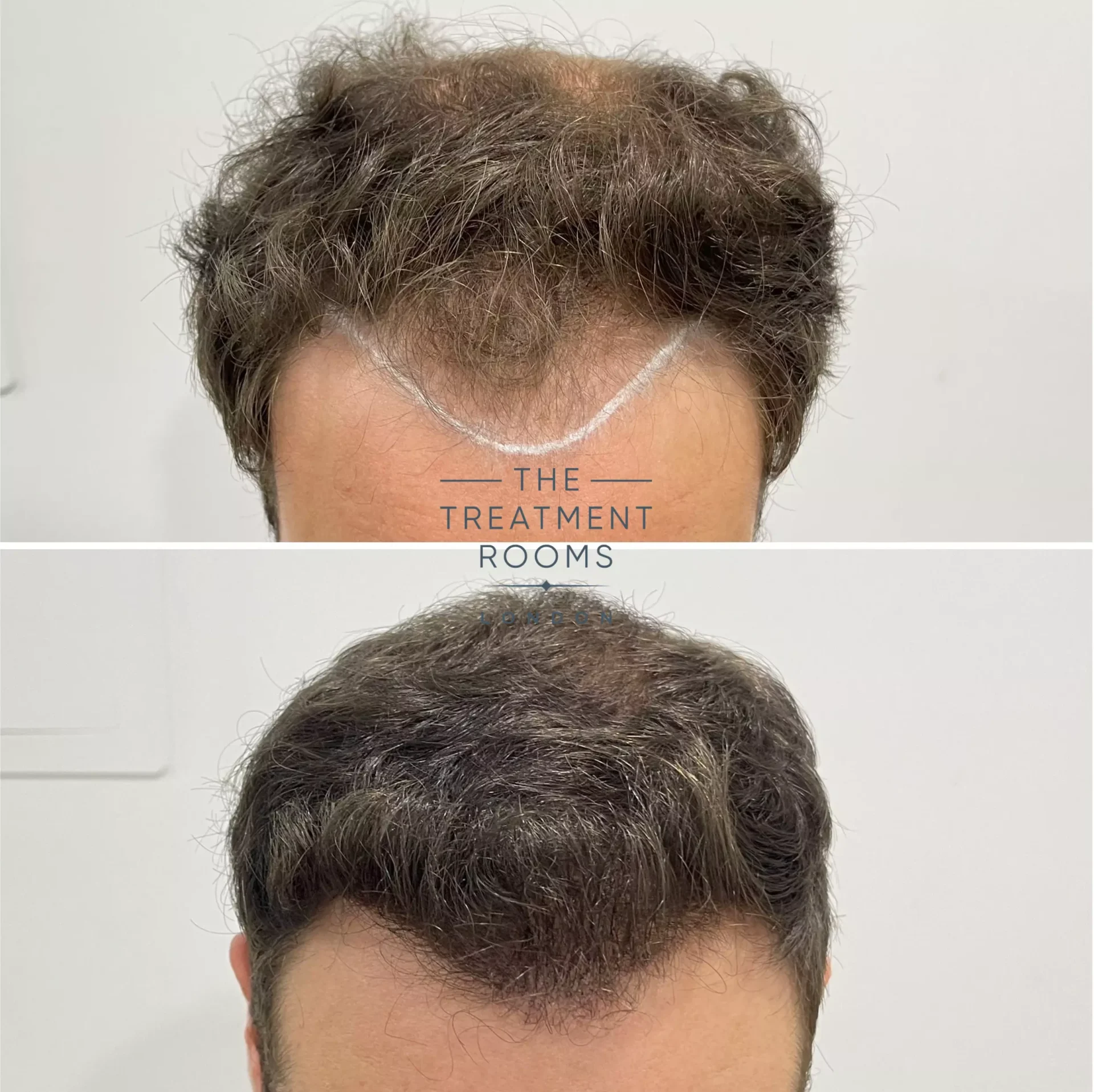 receding hairline transplant london 1736 grafts before and after