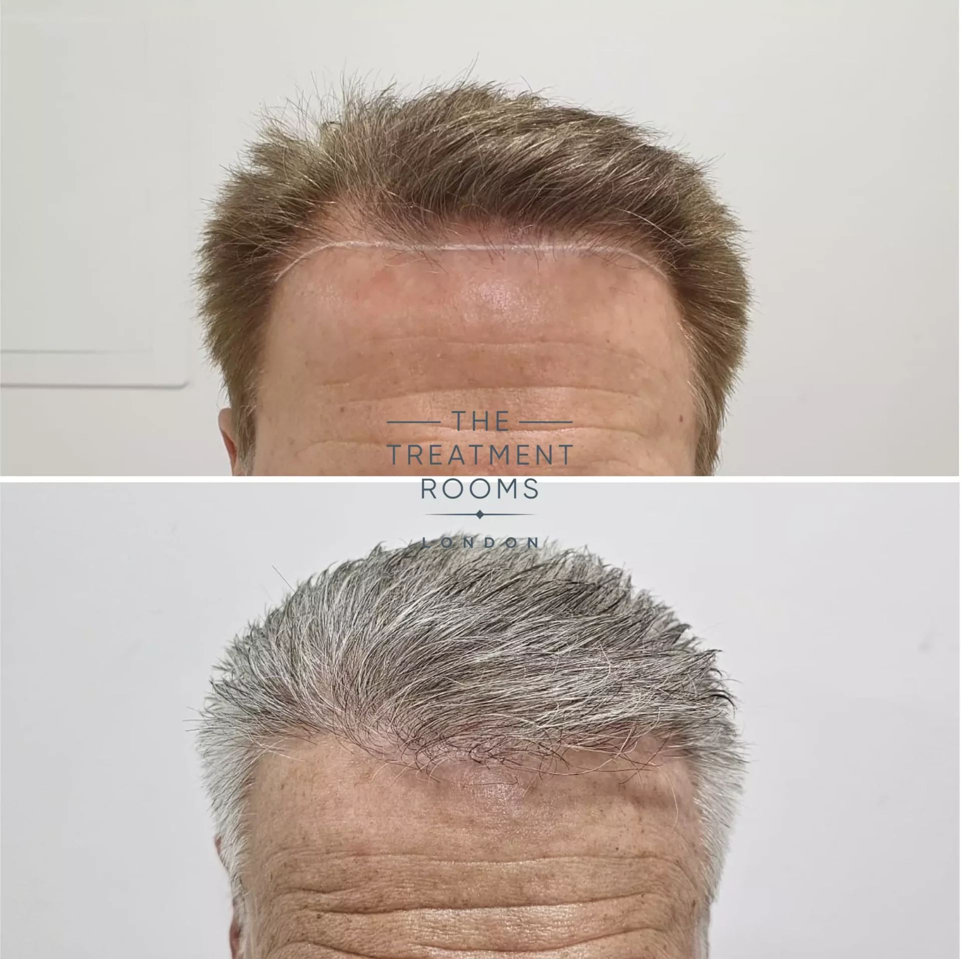 receding hairline transplant result 2126 grafts