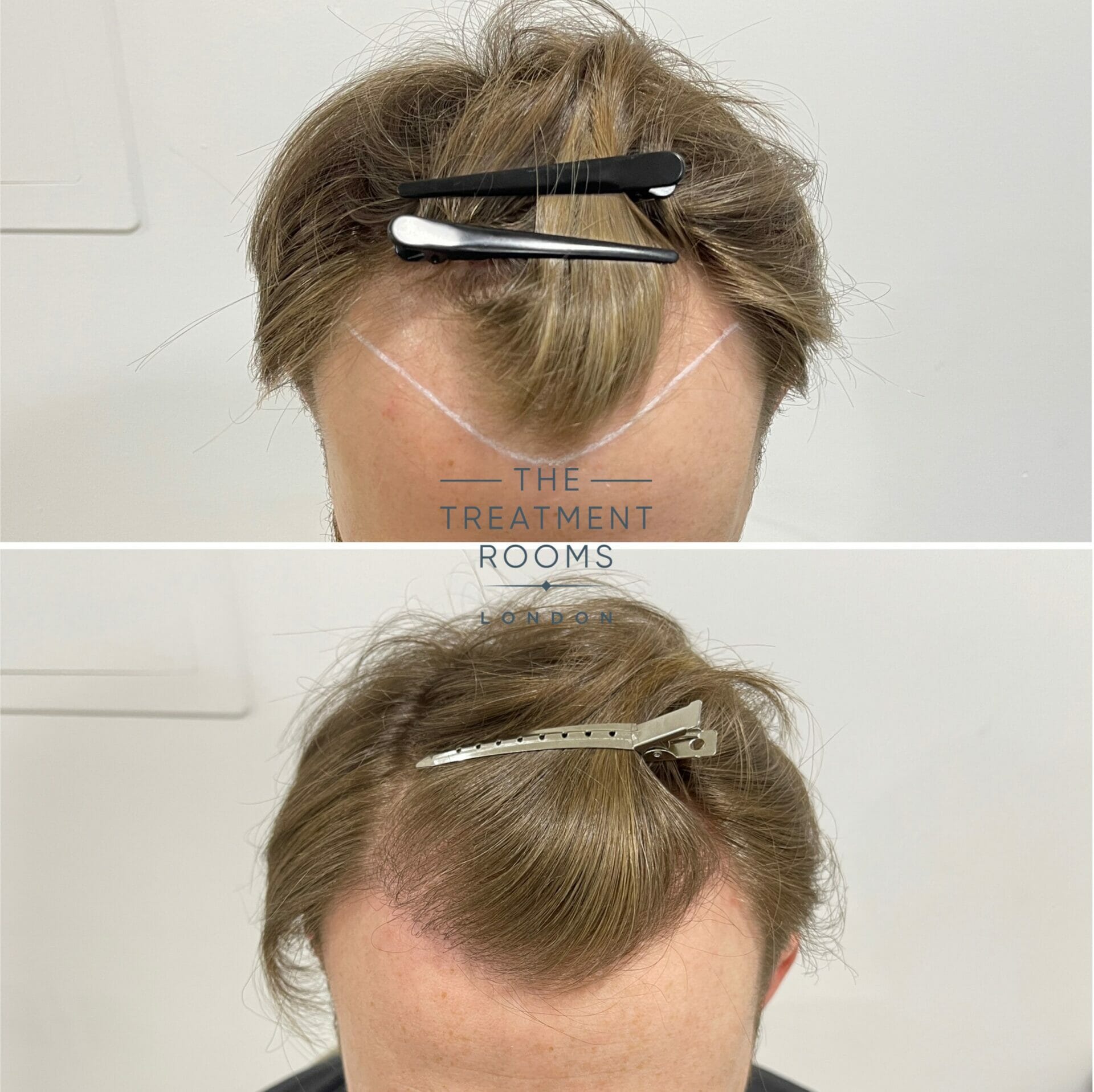 receding hairline treated to mature hairline position with hair transplant