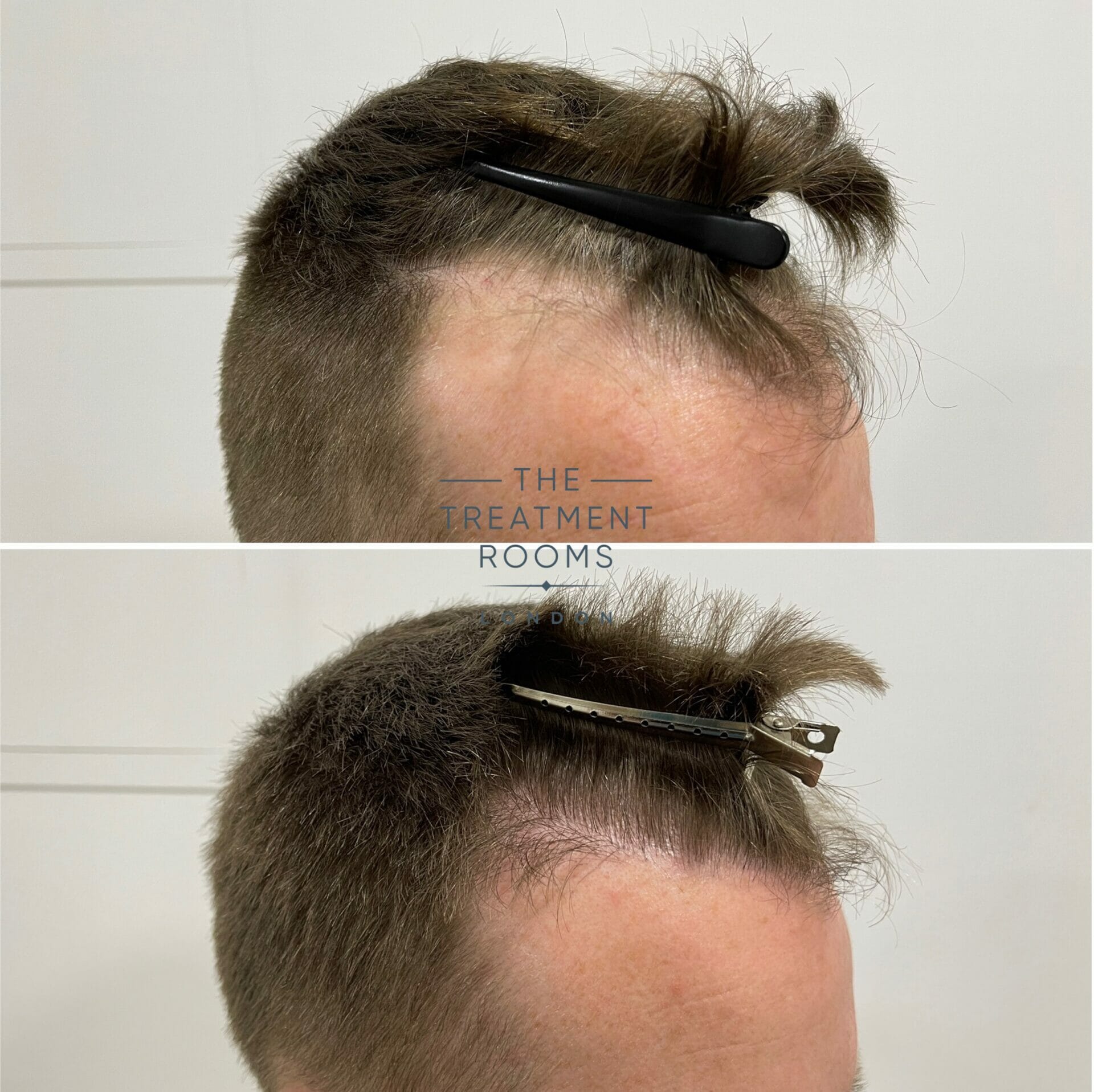 receding temples fue hair transplant before and after