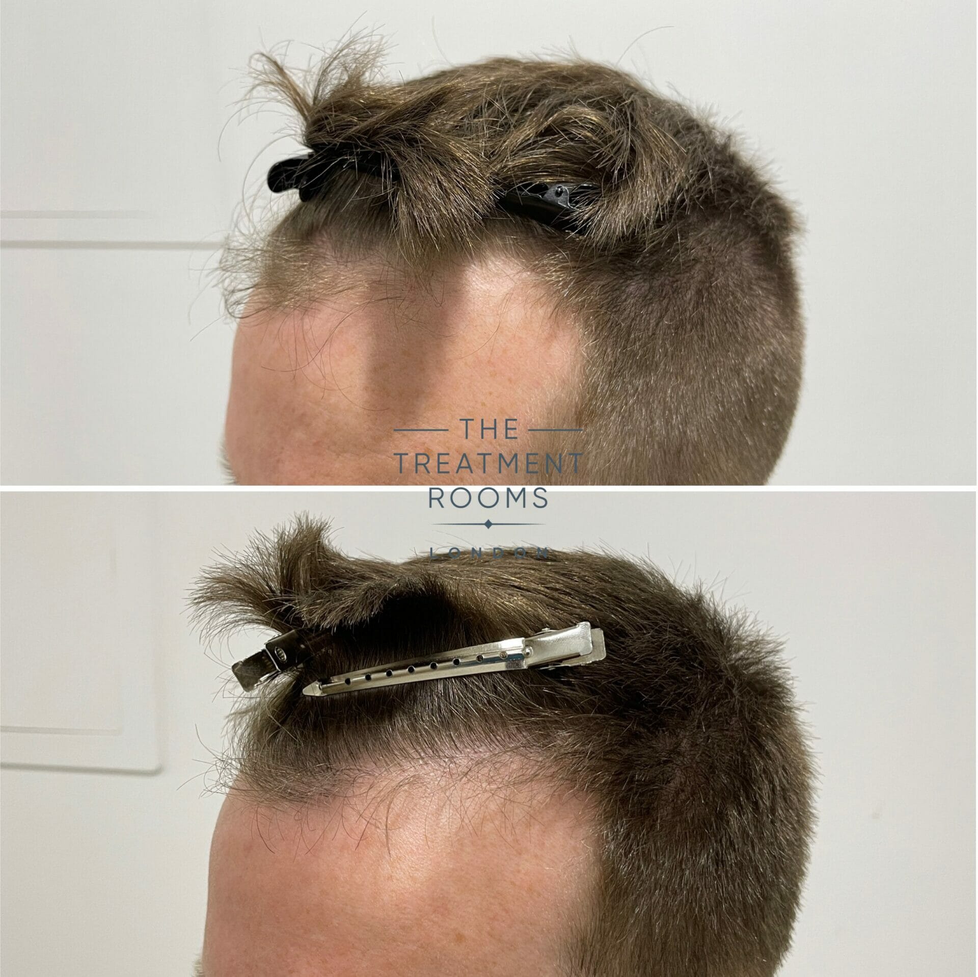 receding temples hair transplant before and after closeup