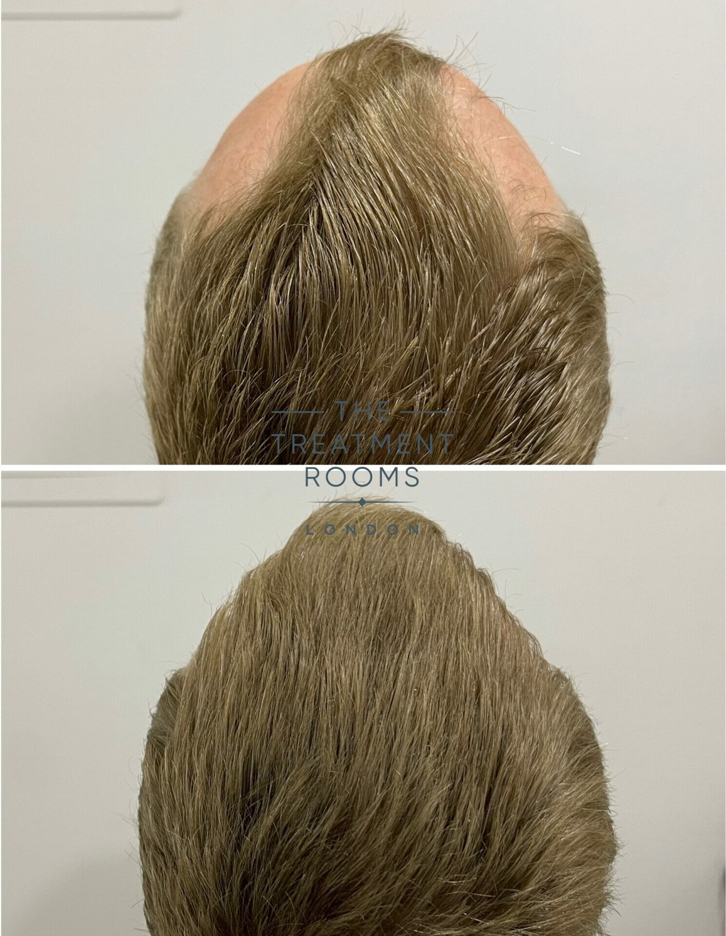 repair fue hair transplant before and after