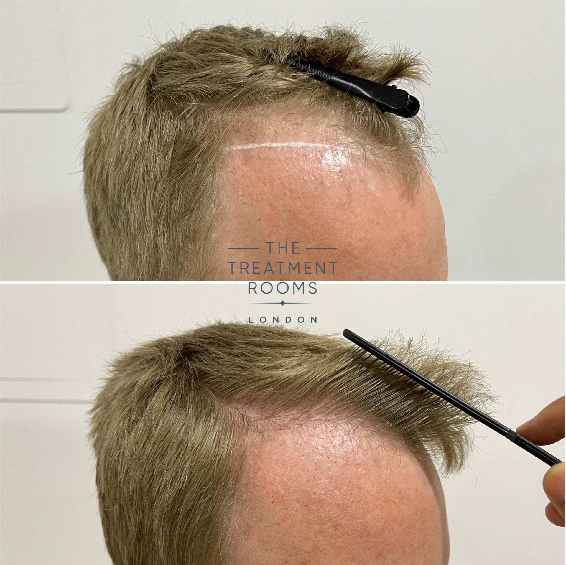 repair hair transplant before and after 1020 grafts