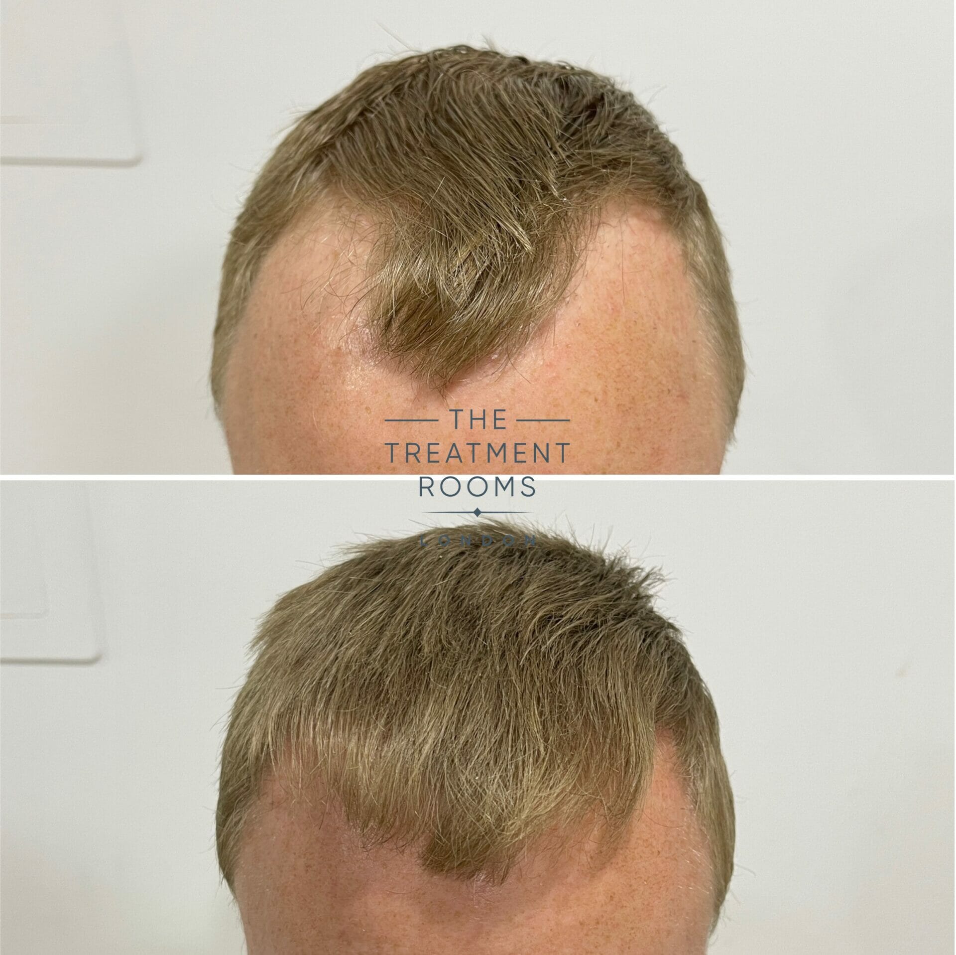 repair hair transplant before and after