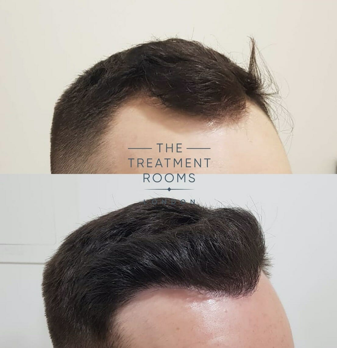 right frontal hairline hair transplant