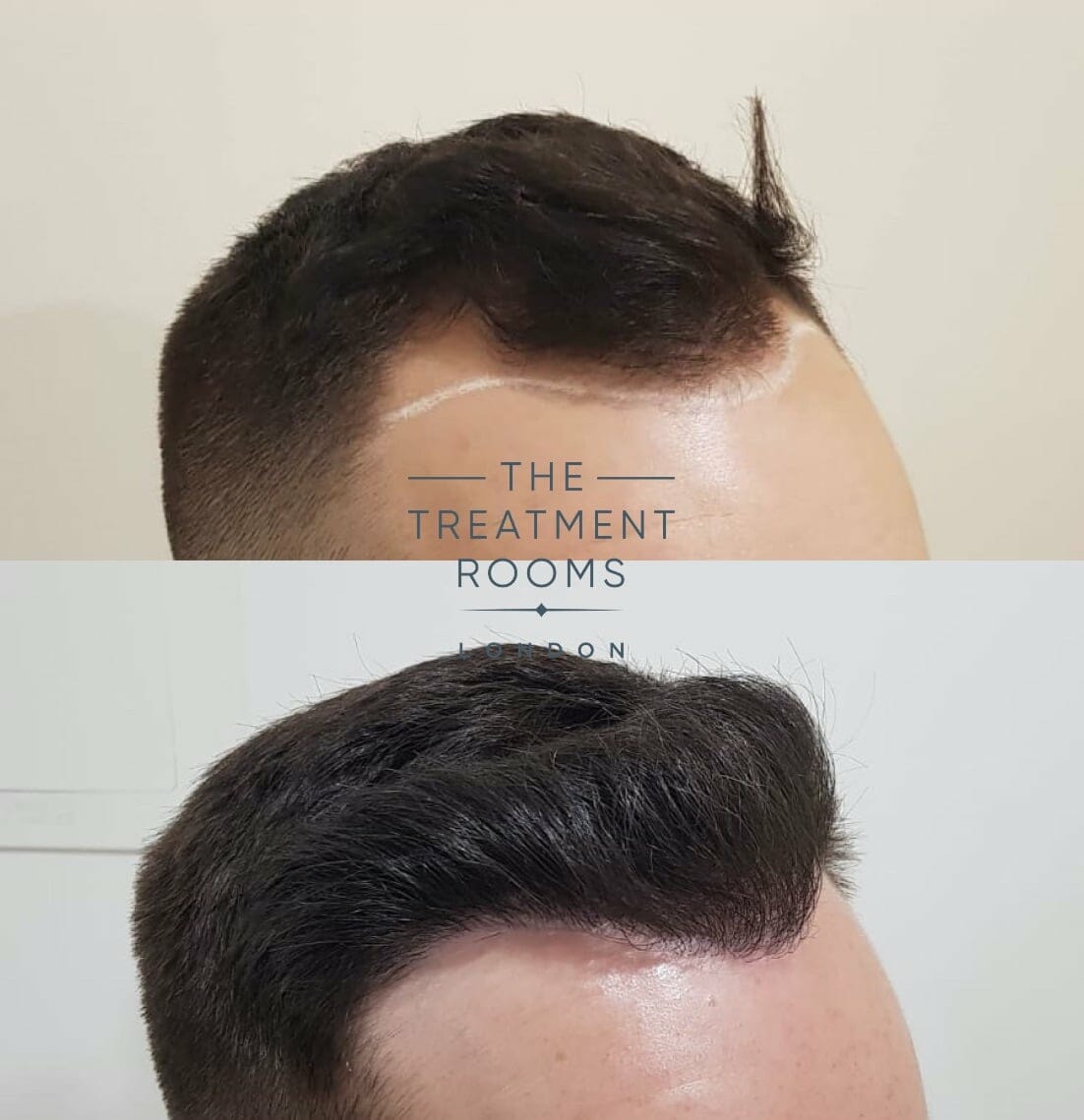 hairline fue hair transplant before after 1292 grafts