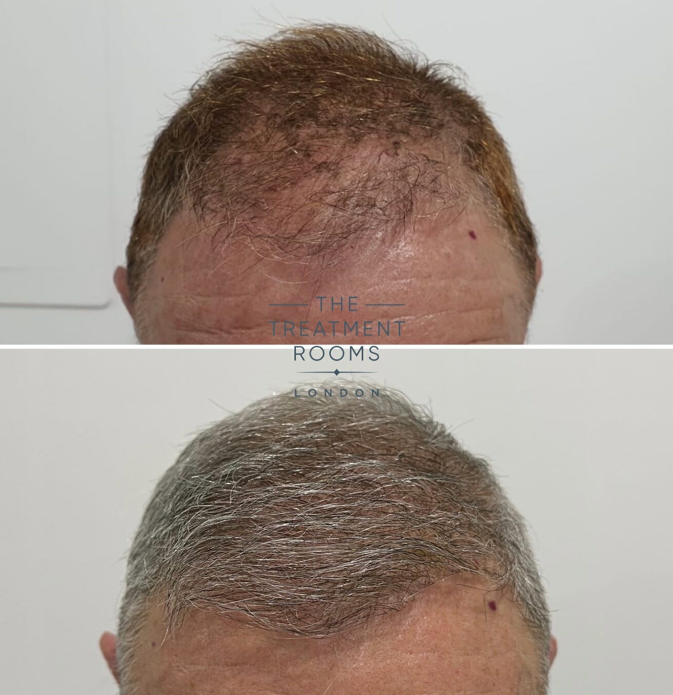 second hair transplant