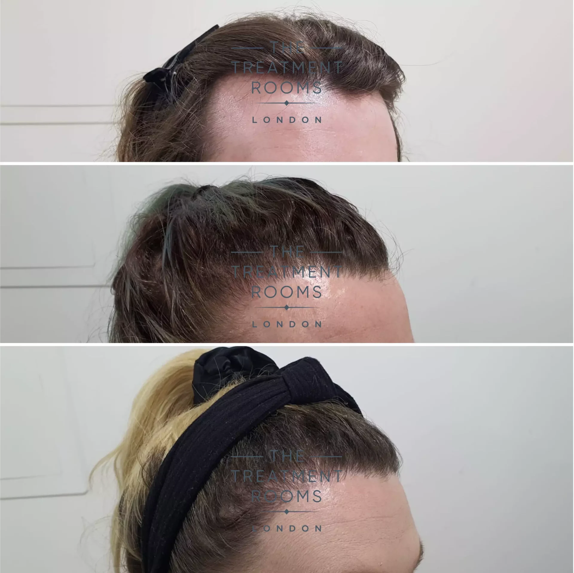 second stage hairline transgender hair transplant london 2319 grafts before and after