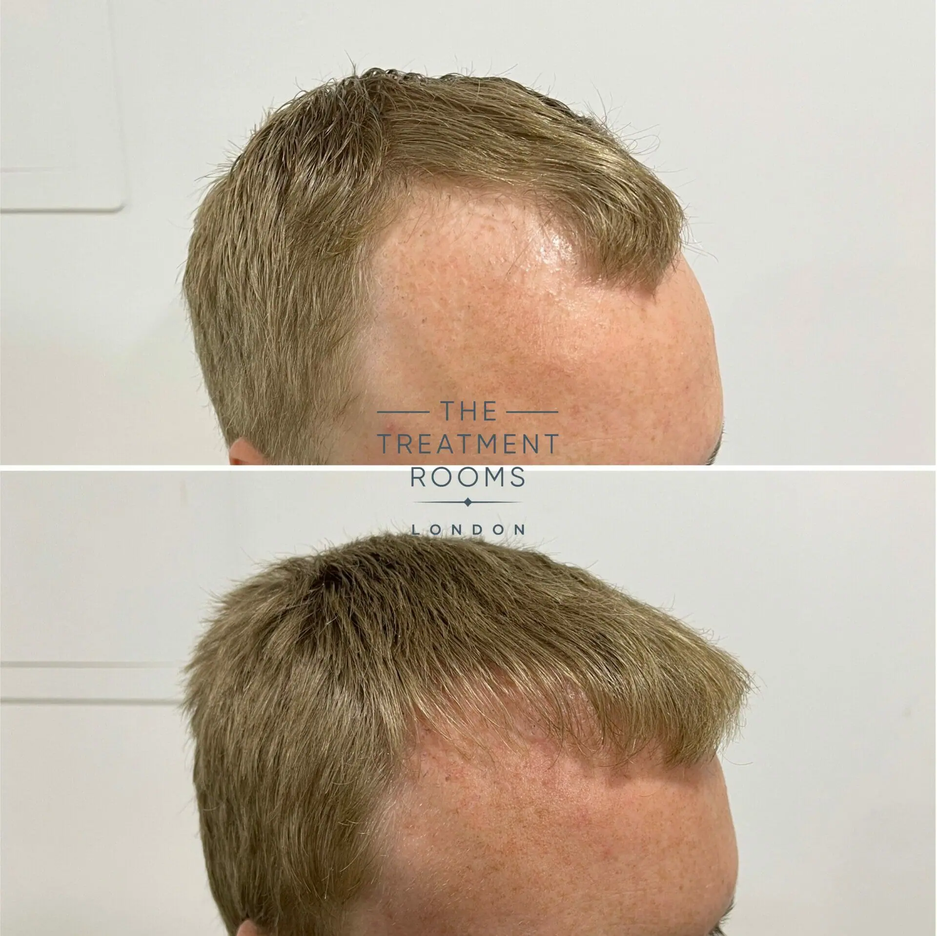 Hair plugs cost deals
