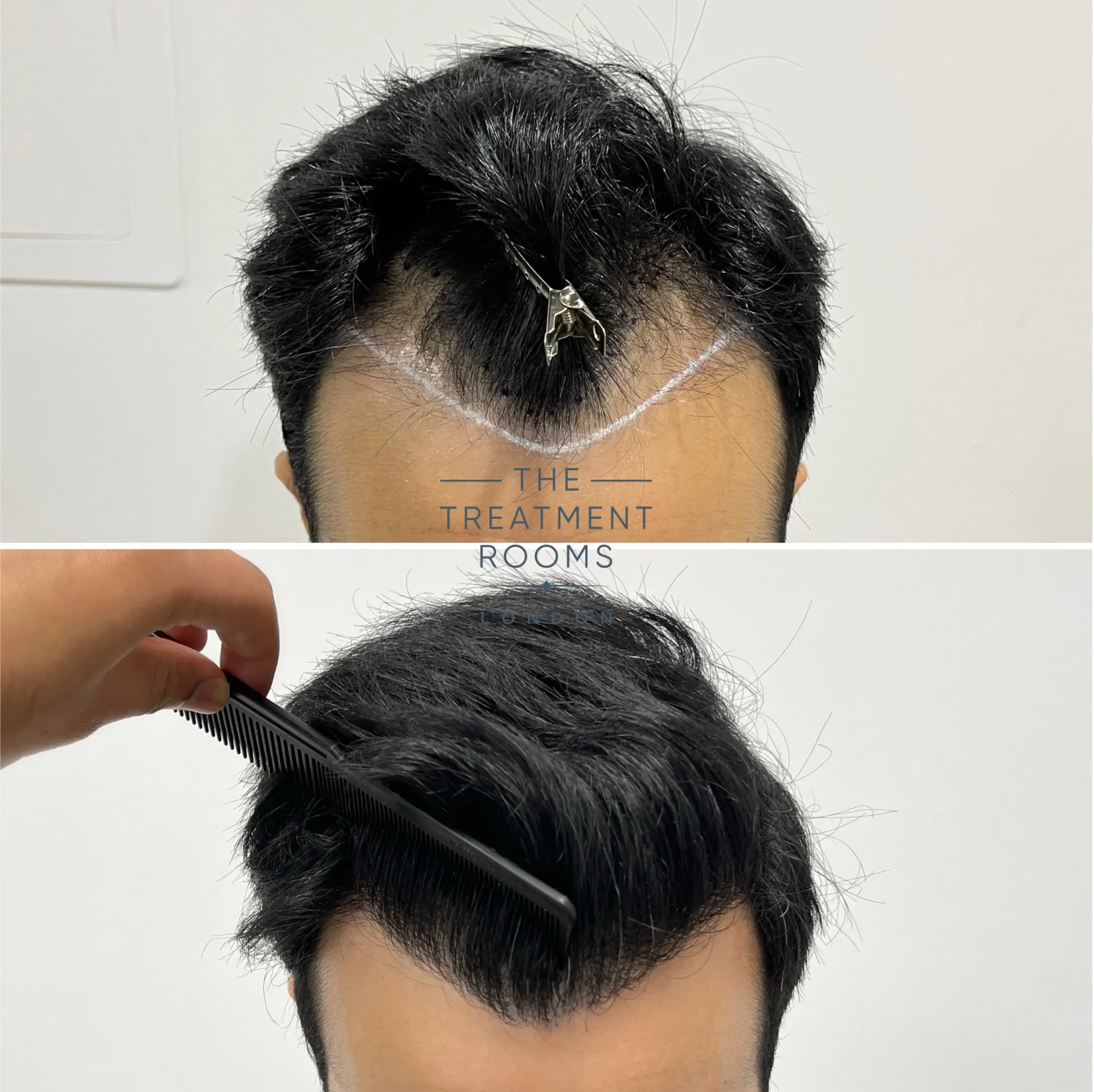 stopping a maturing hairline