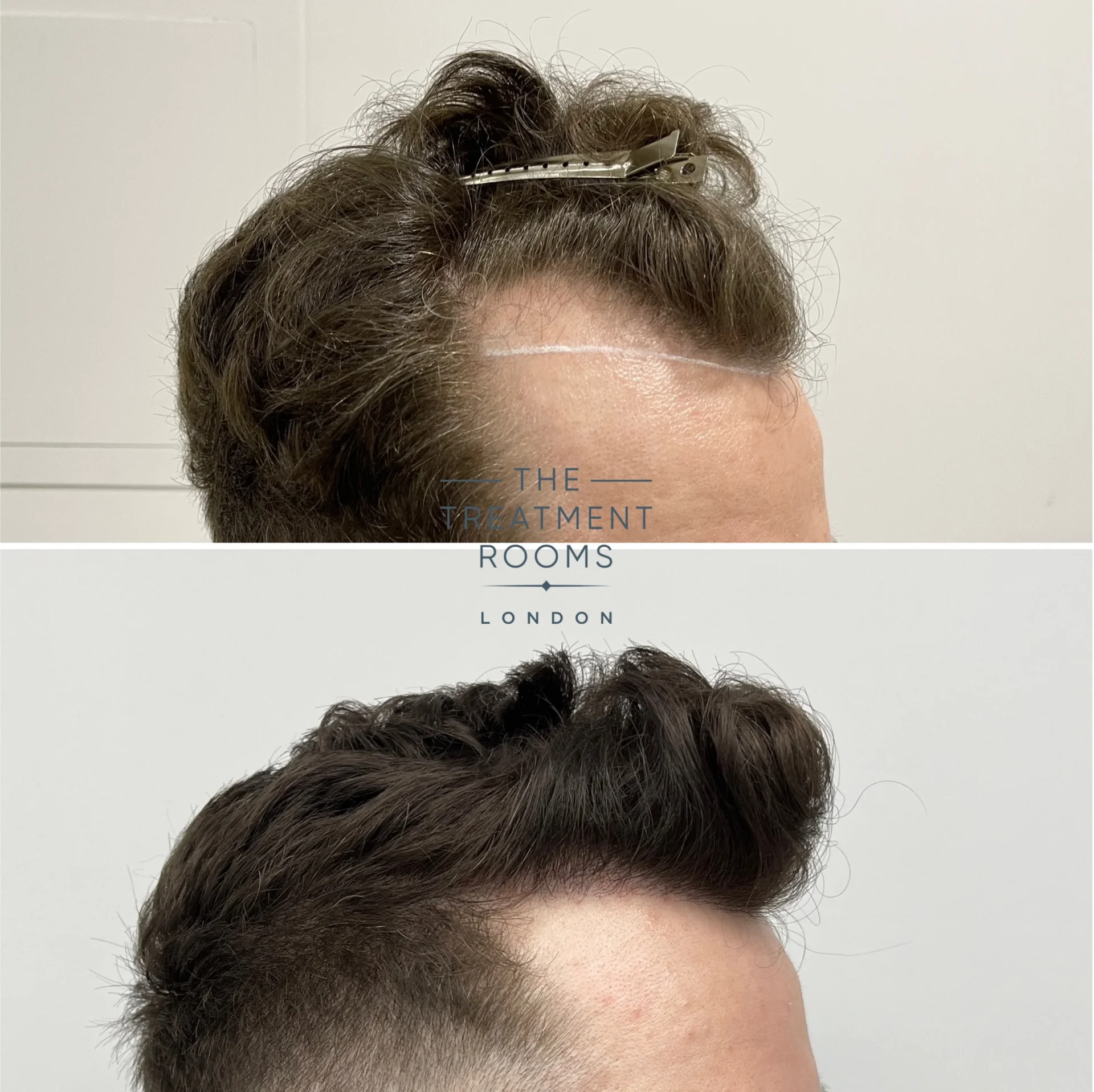 temple fue hair transplant 1145 grafts before and after