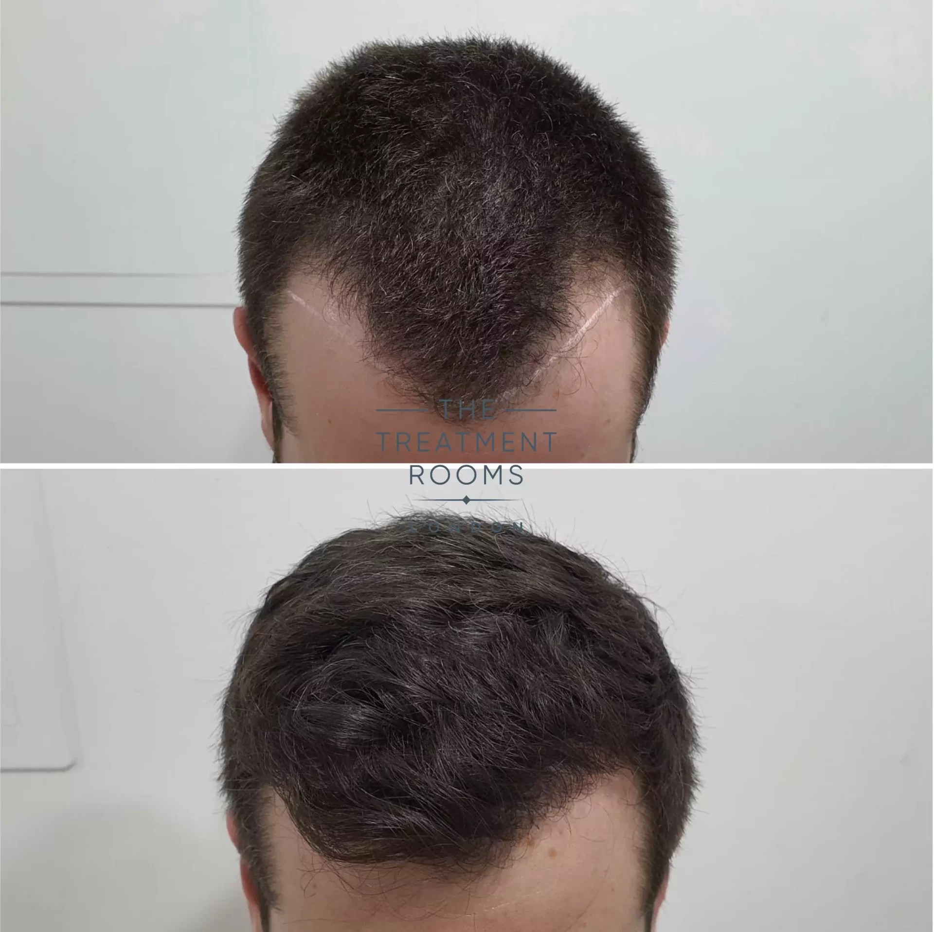 temple fue hair transplant 1297 grafts before and after