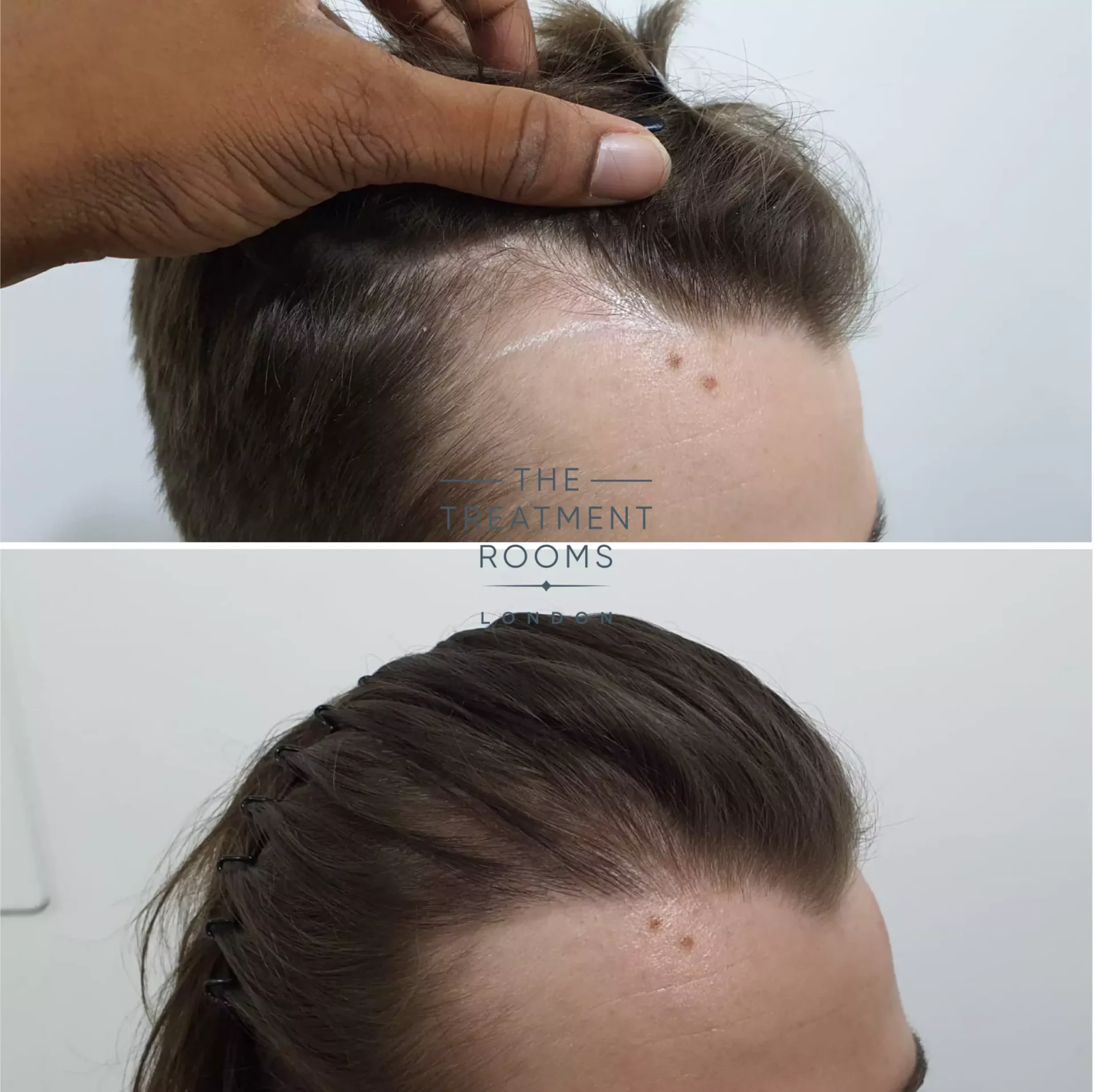 temple fue hair transplant 600 grafts before and after