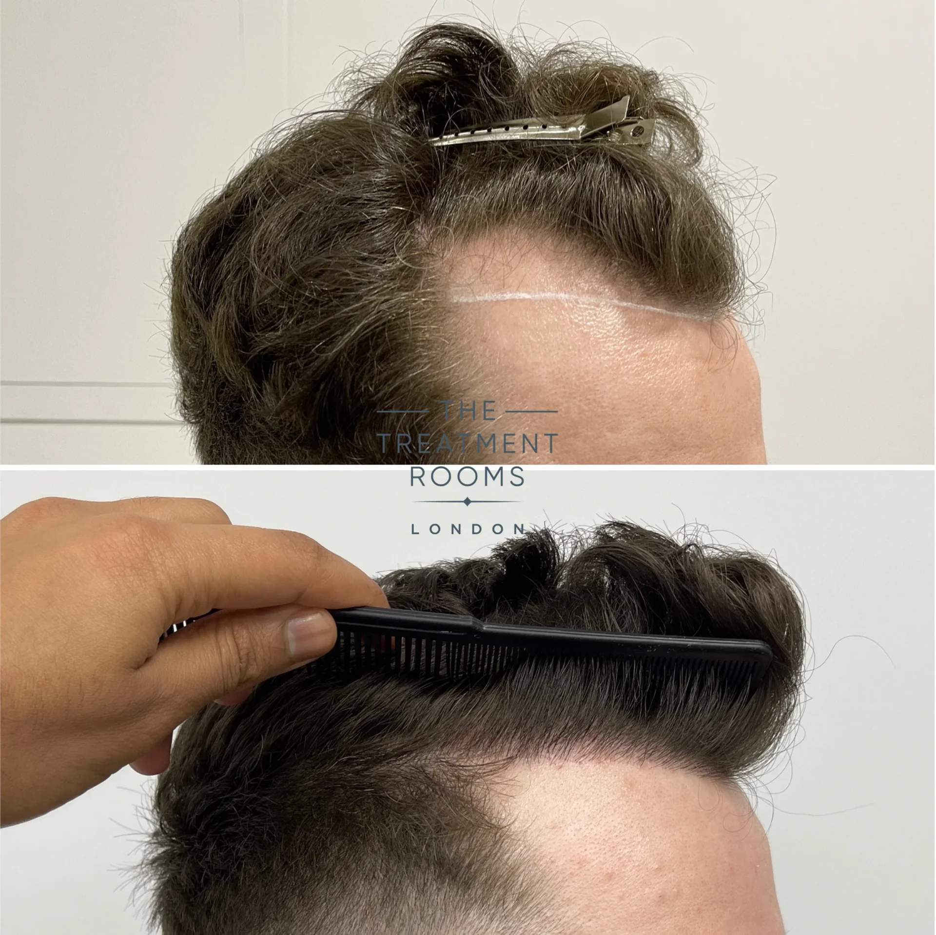 temple hair transplant 1145 grafts before and after detailed